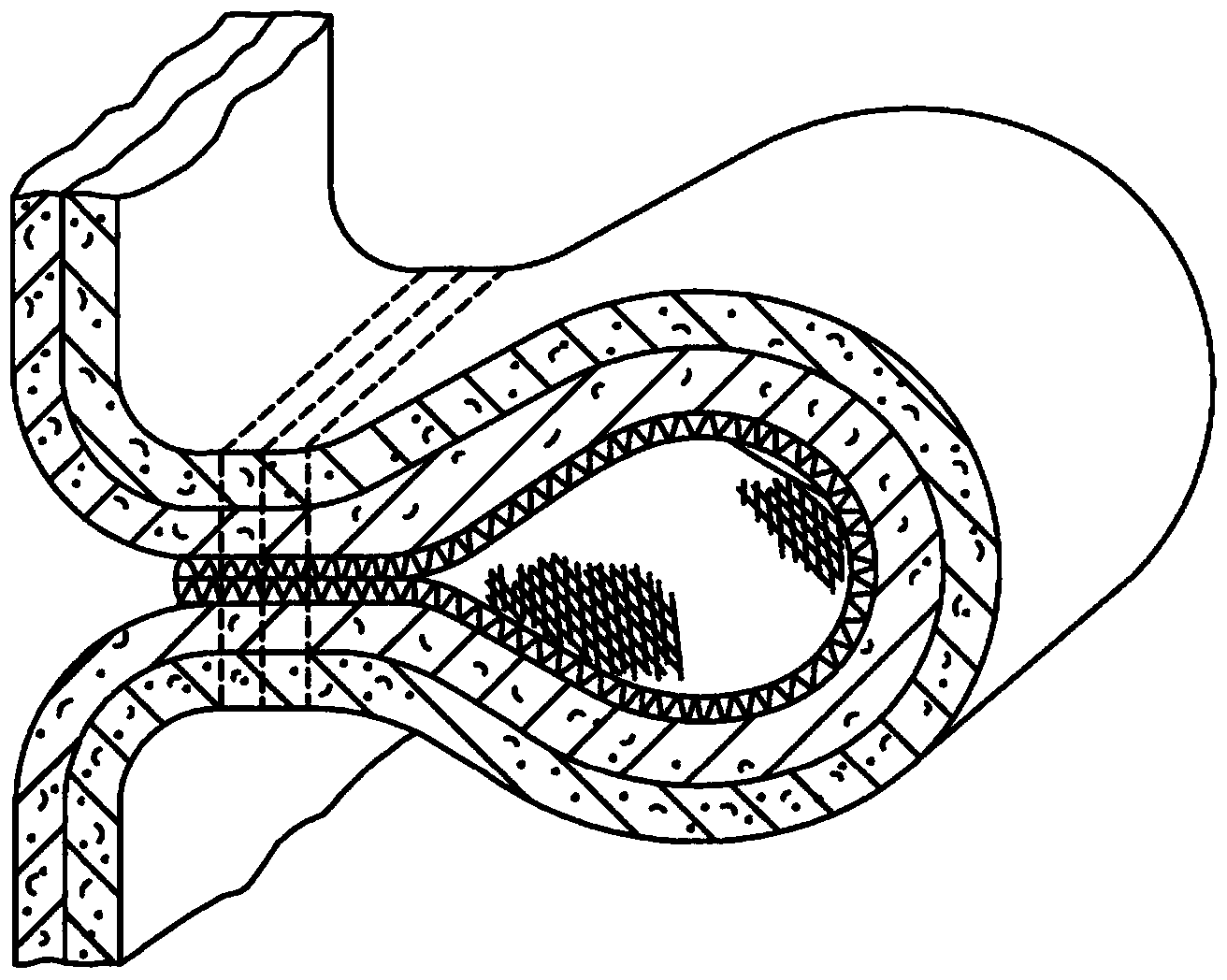 Endolumenal esophageal restriction device