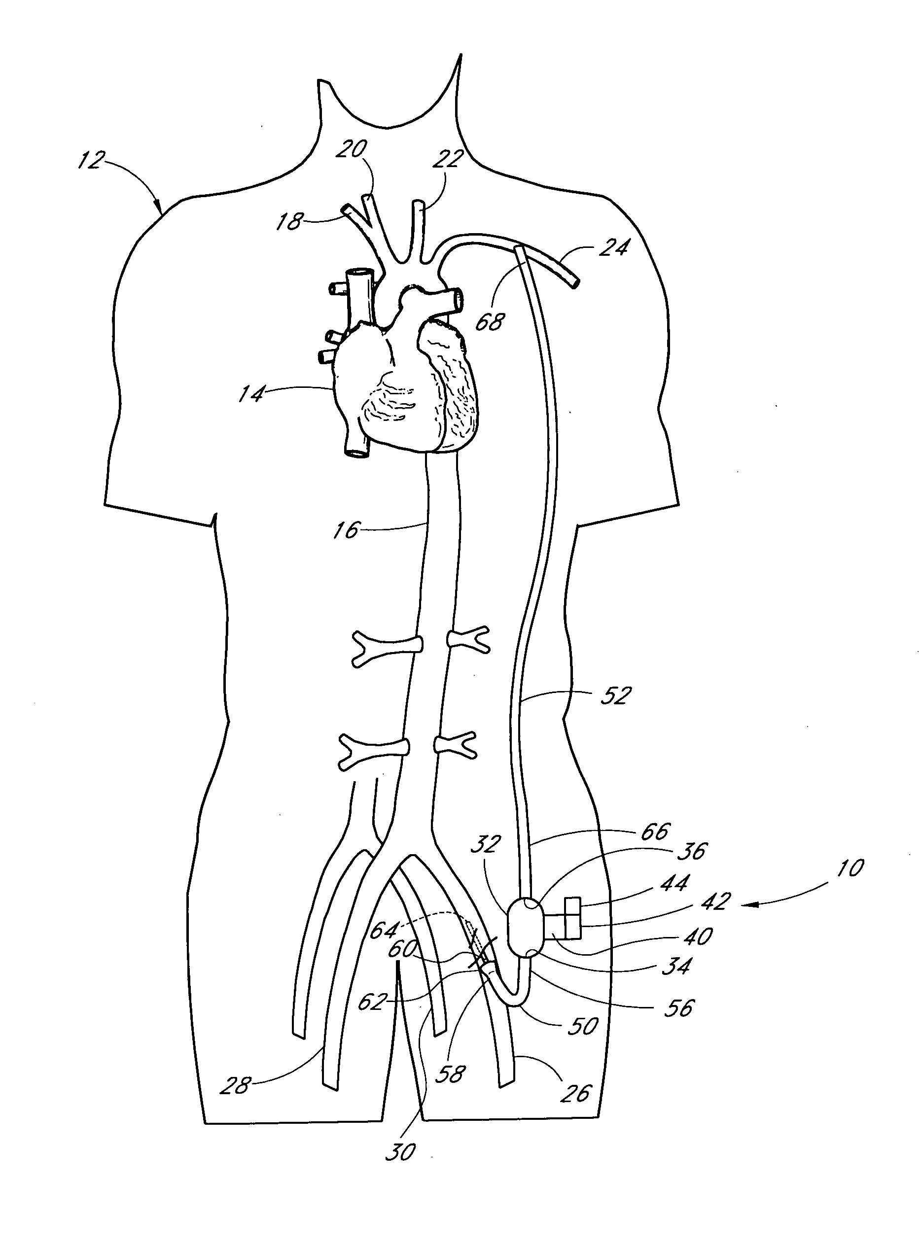 Blood conduit connector