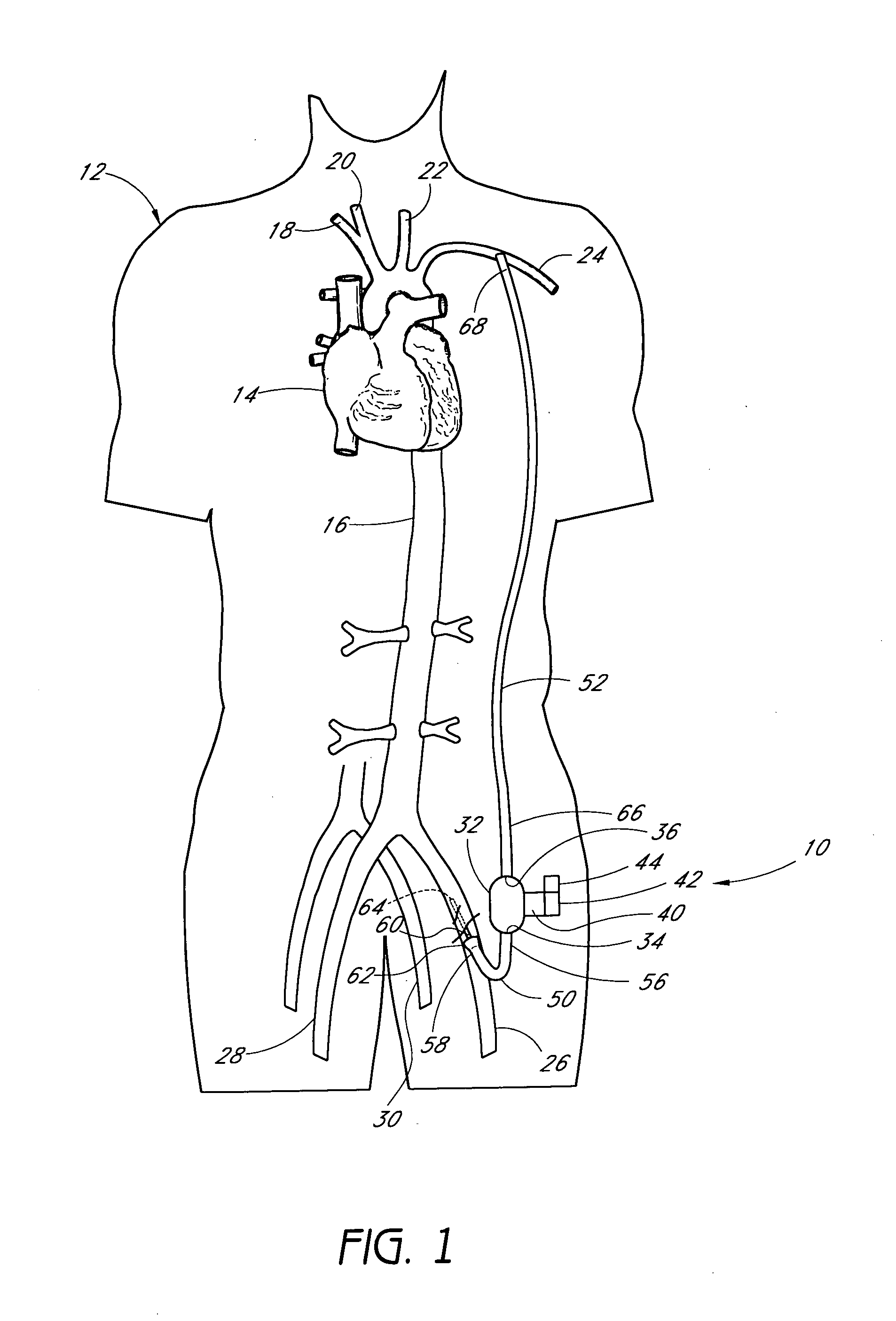 Blood conduit connector