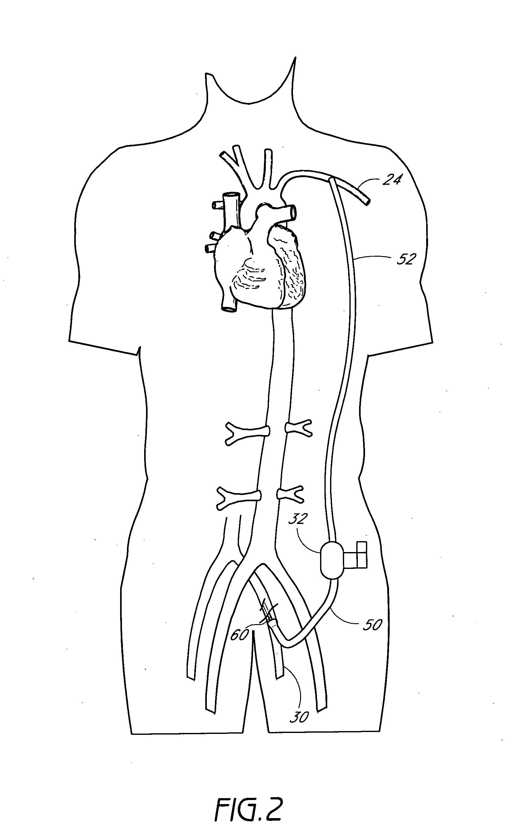 Blood conduit connector