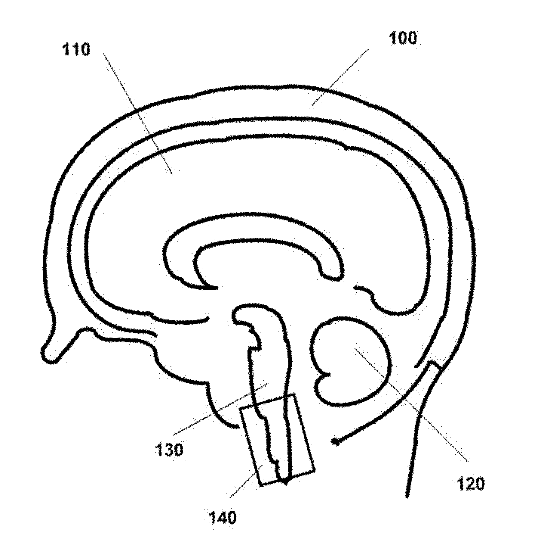 Ultrasound neuromodulation of the reticular activating system