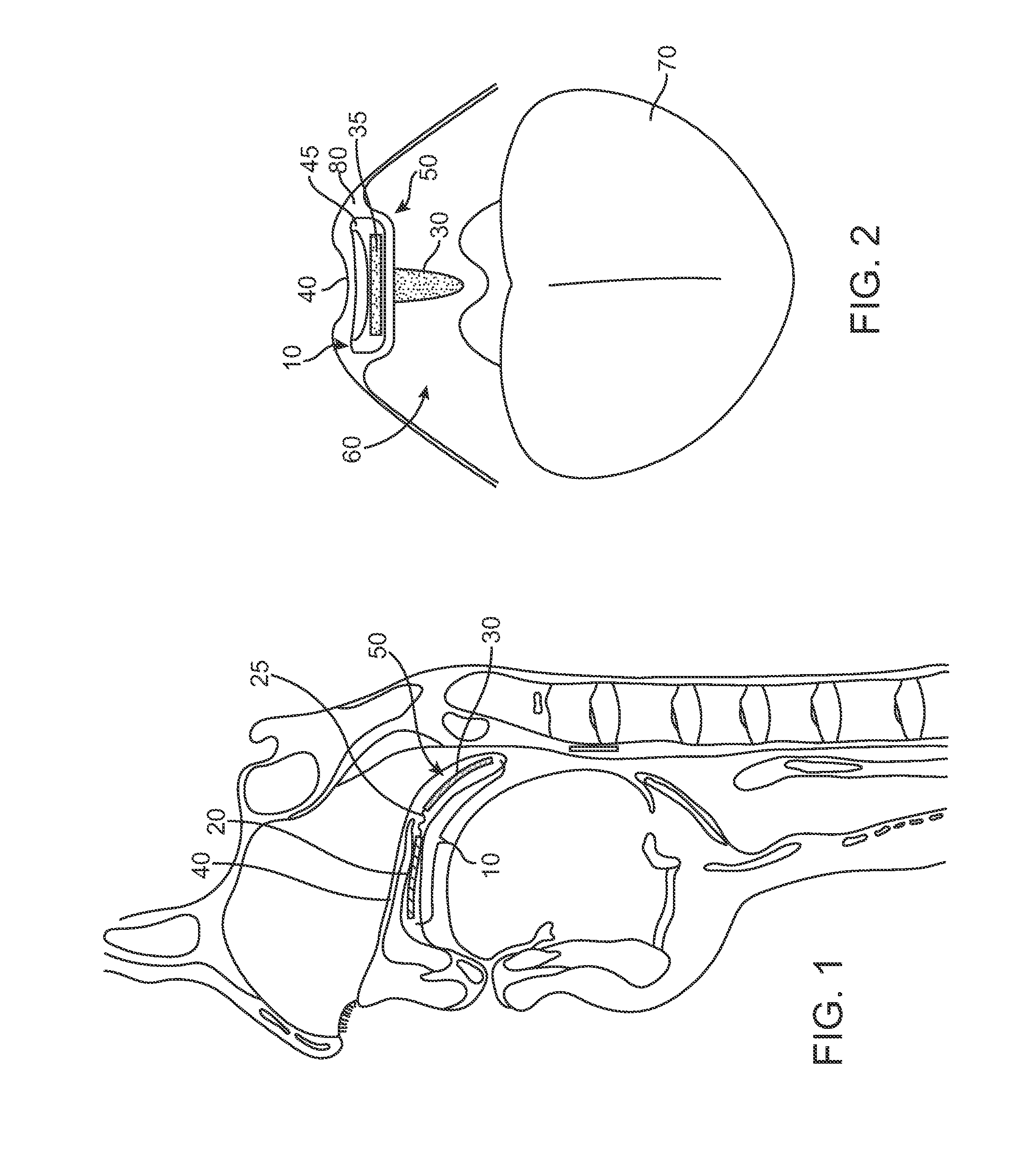 Detection of implant functionality