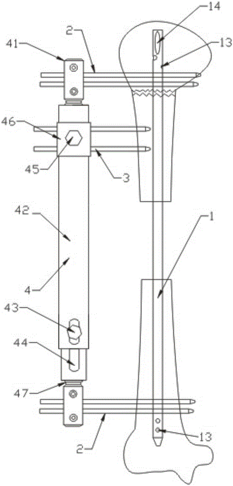 Bone transport device used for massive bone defects