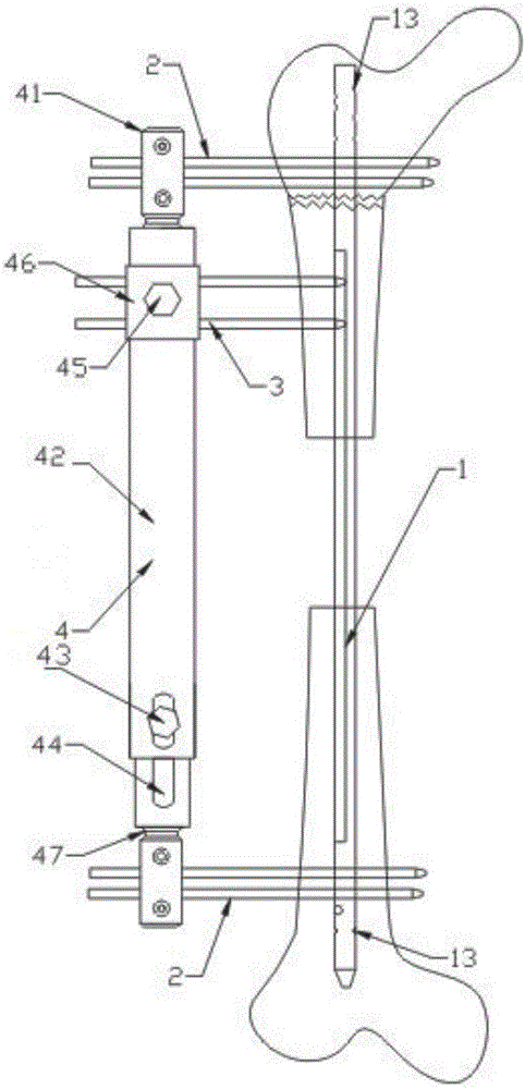 Bone transport device used for massive bone defects