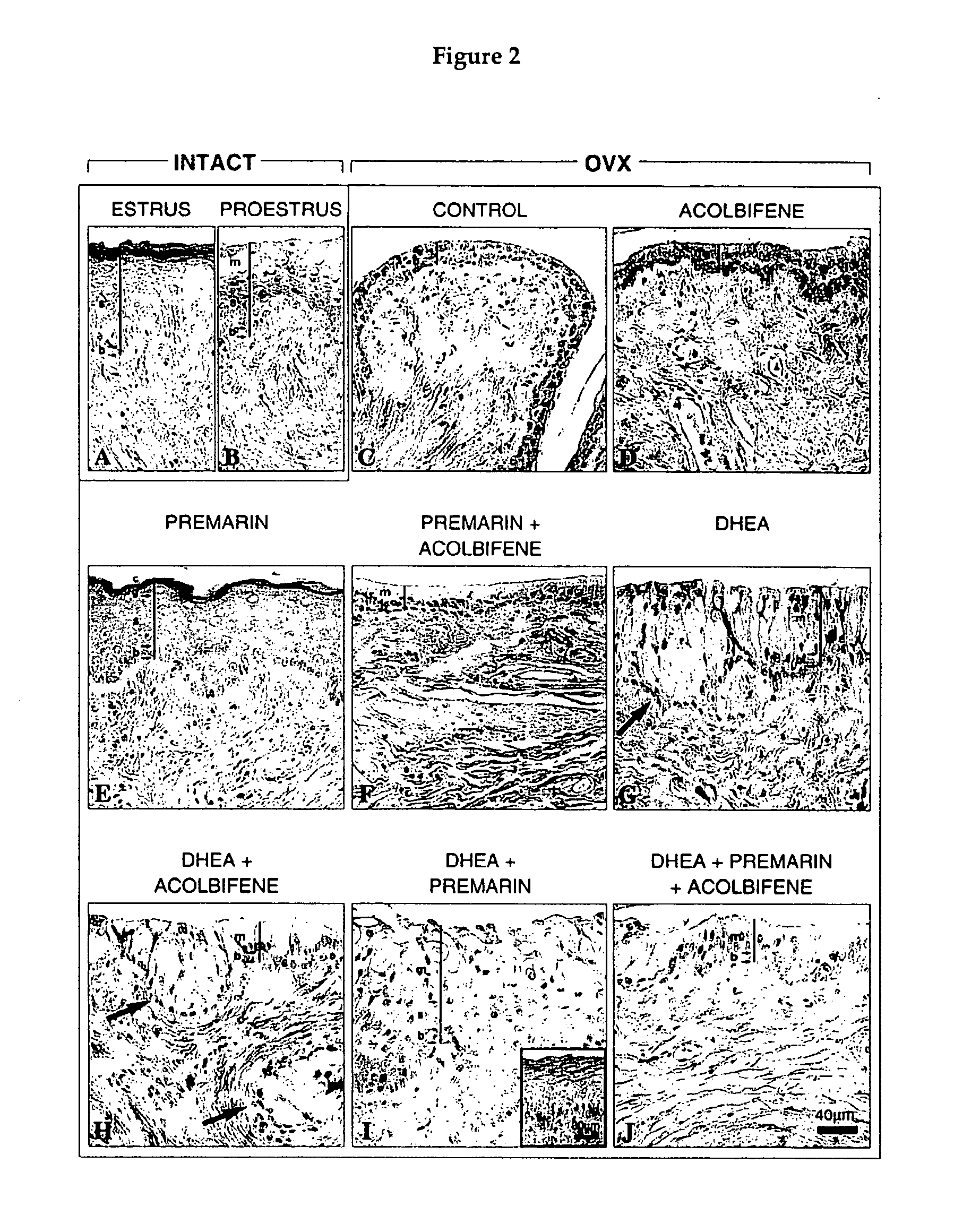 Sex steroid precursor alone or in combination with a selective estrogen receptor modulator and/or with estrogens and/or a type 5 cGMP phosphodiesterase inhibitor for the prevention and treatment of vaginal dryness and sexual dysfunction in postmenopausal women