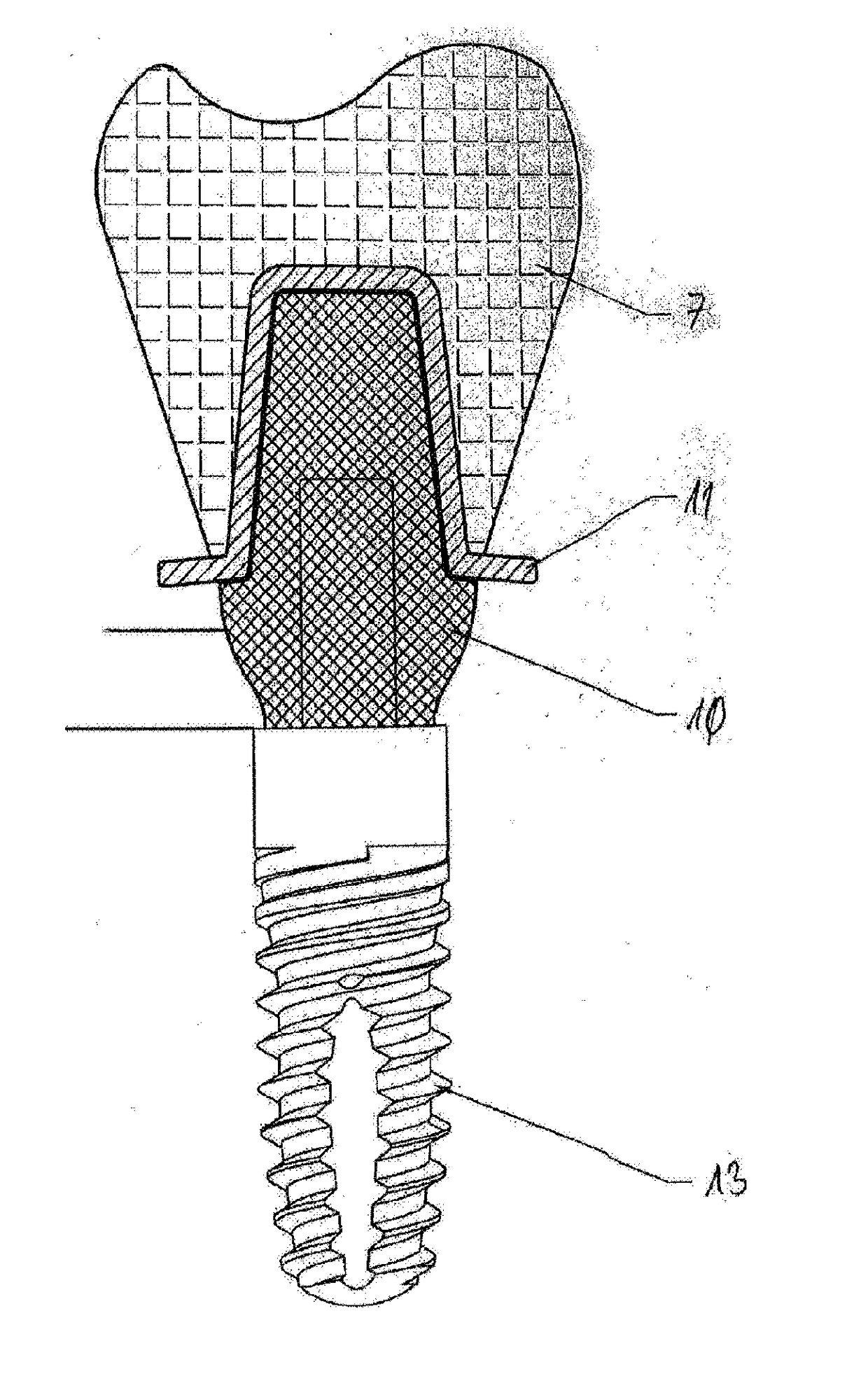 Method of making a dental prosthesis