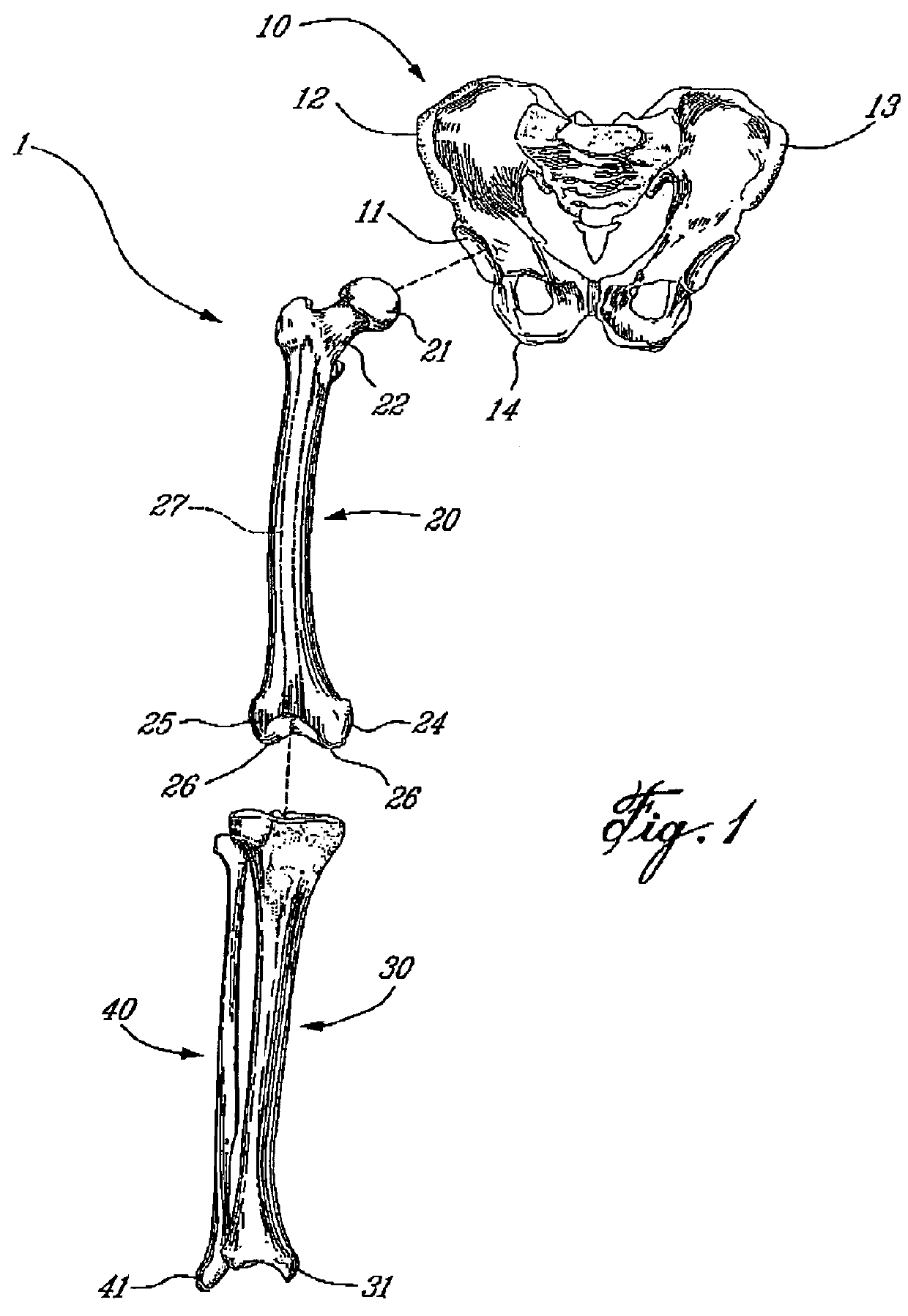 Computer-assisted hip replacement surgery