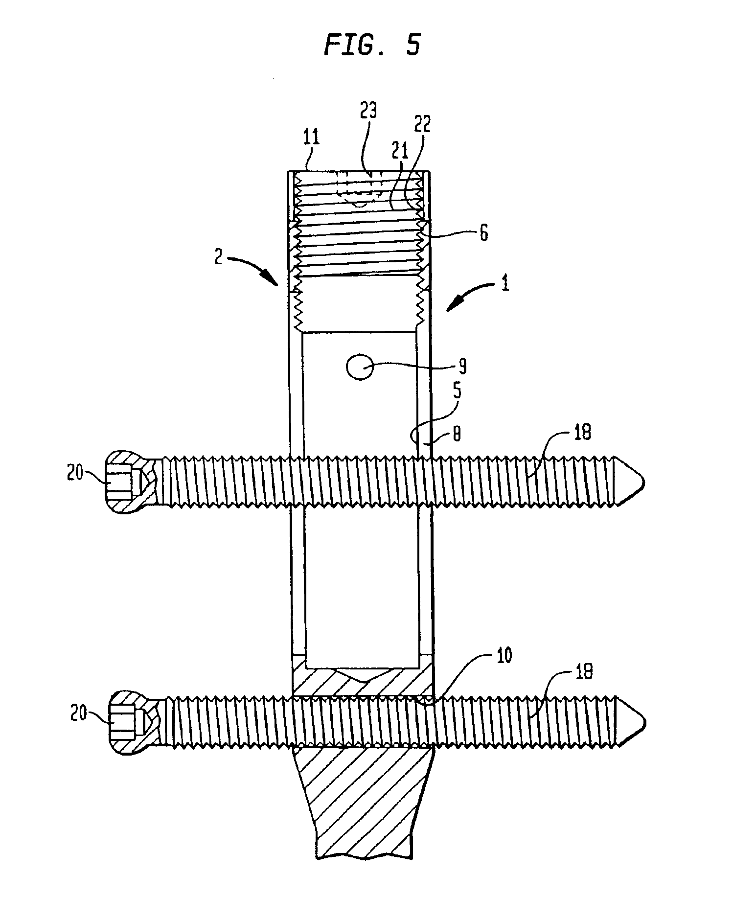 Modular intramedullary nail