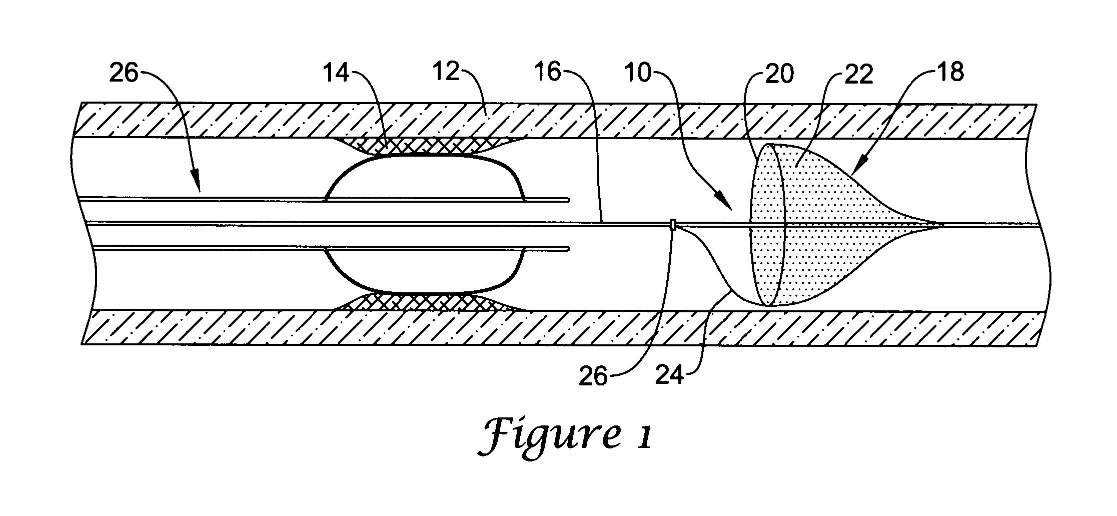 Sheath for use with an embolic protection filter