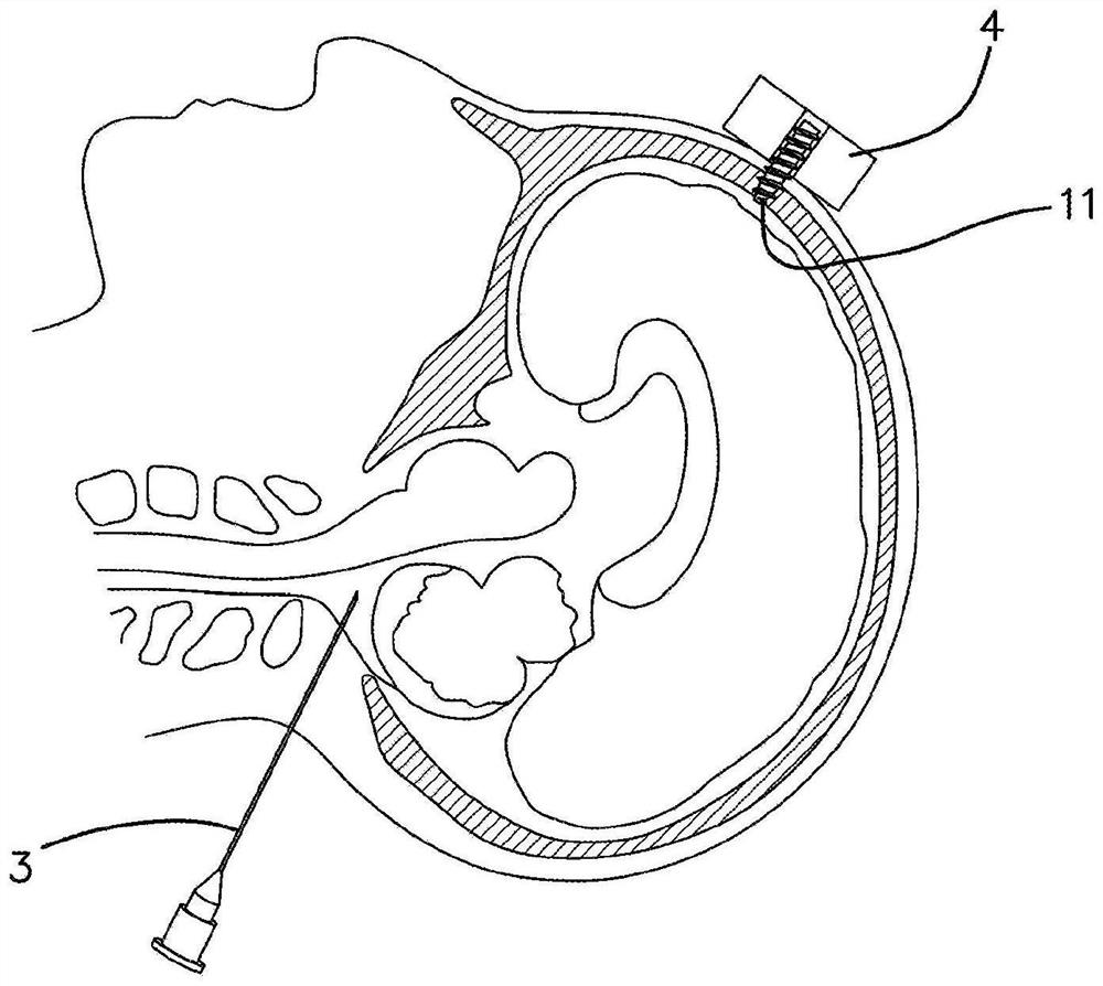 Device and method for cooling brain and diagnosing and treating glioblastoma