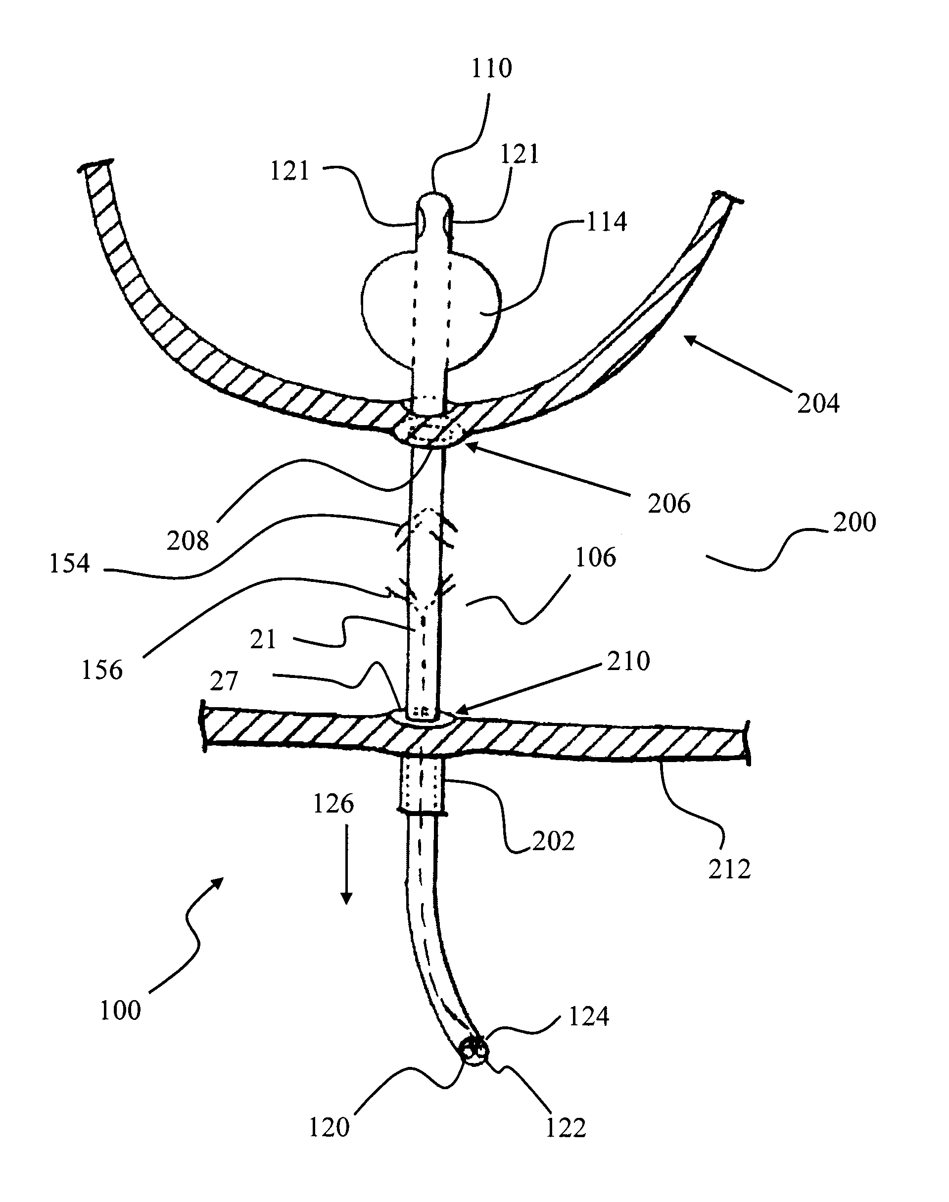 Anastomosis device and related methods