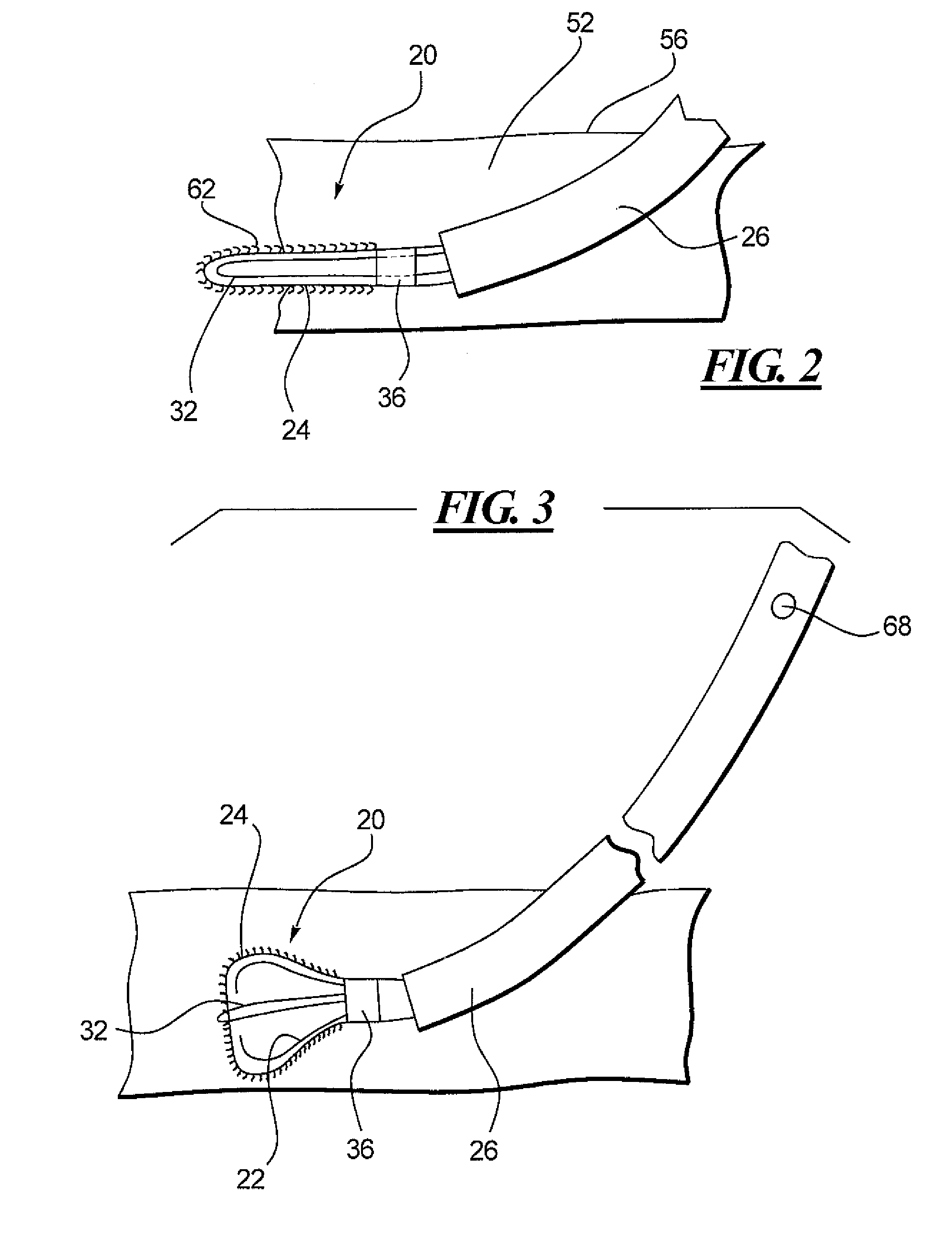 Connective Tissue Closure Device and Method