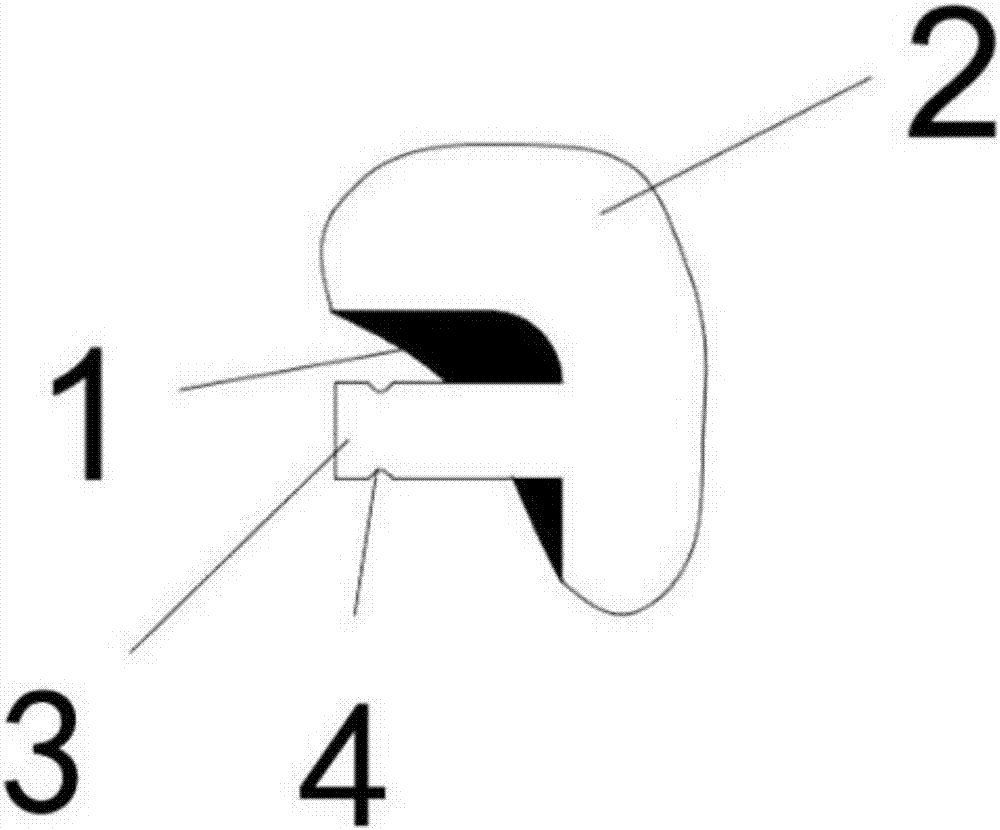 3D-printed detachable transition prosthesis bonded and planted adjacent to teeth