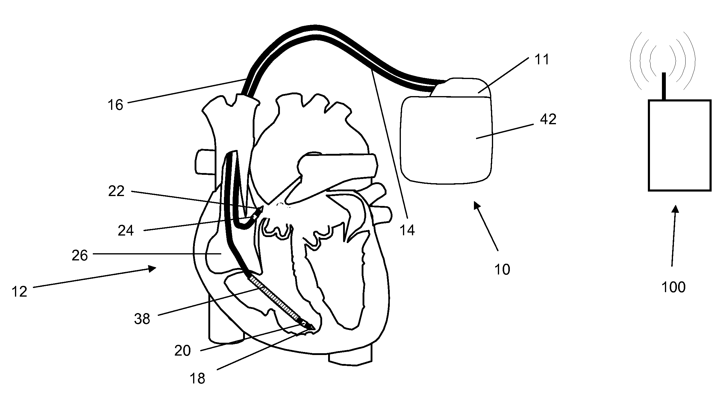 Antitachycardiac heart stimulator