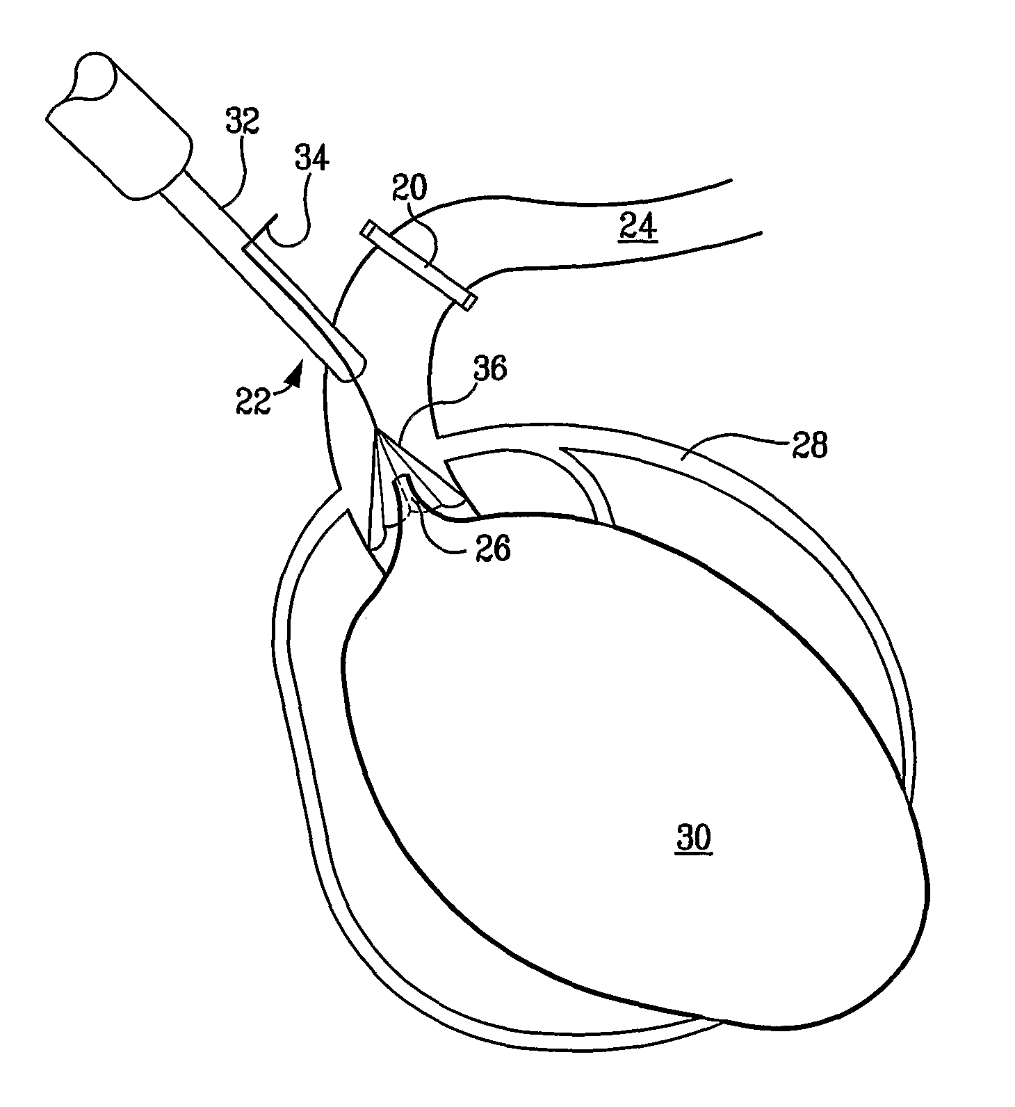 Device for facilitating cardioplegia delivery in patients with aortic insufficiency