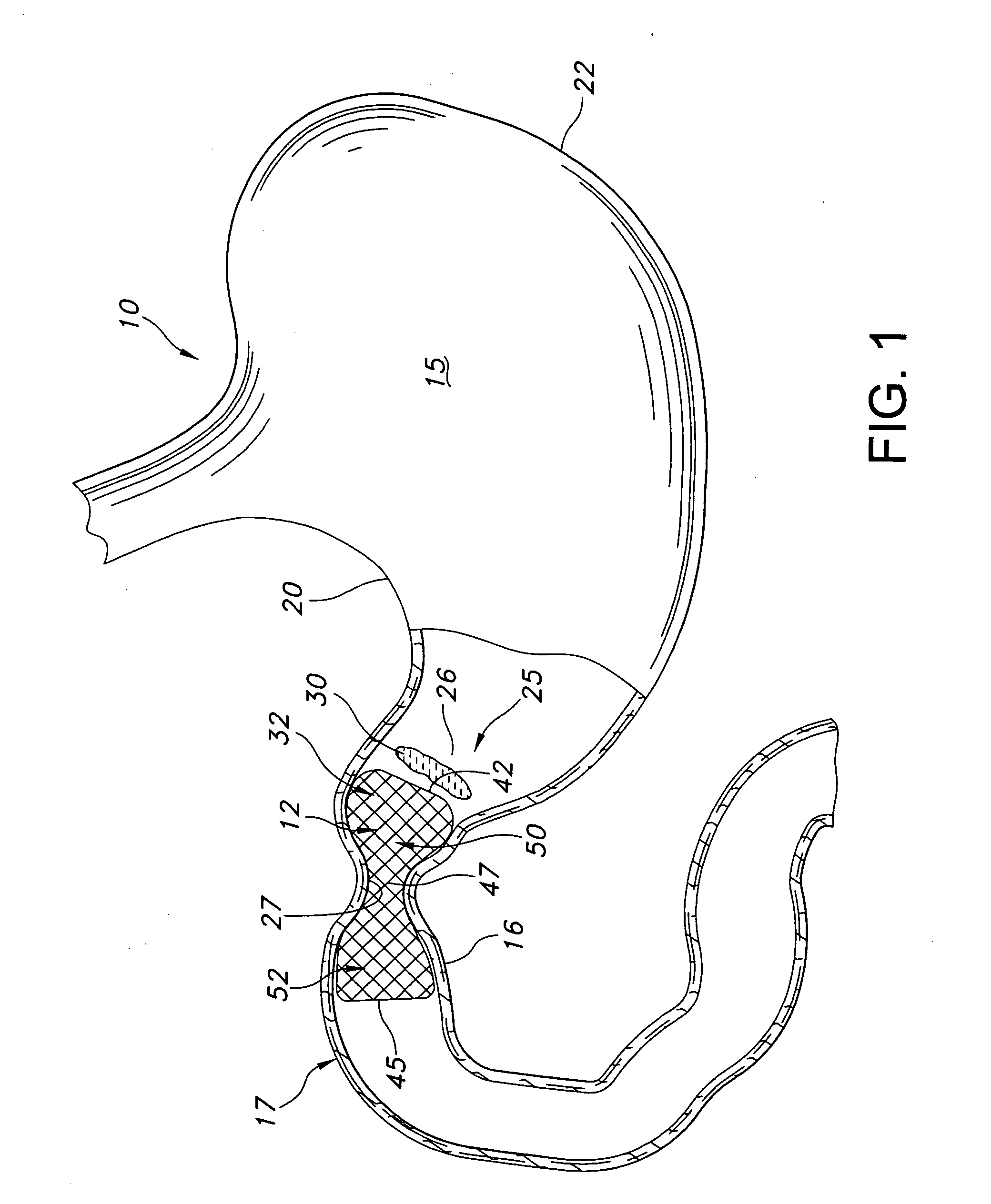 Pyloric obesity valve