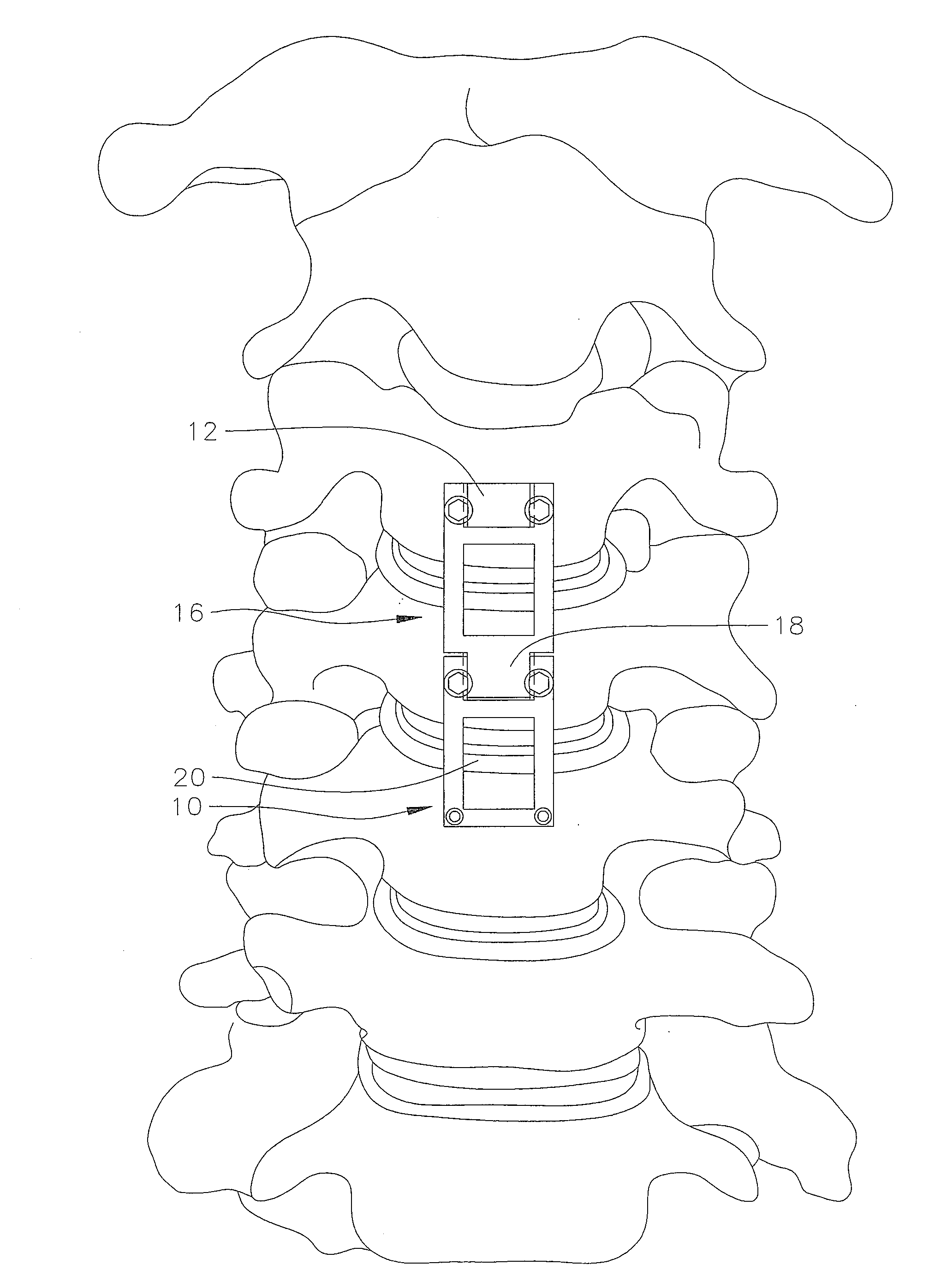 Distraction device for use with a revisable anterior cervical plating system