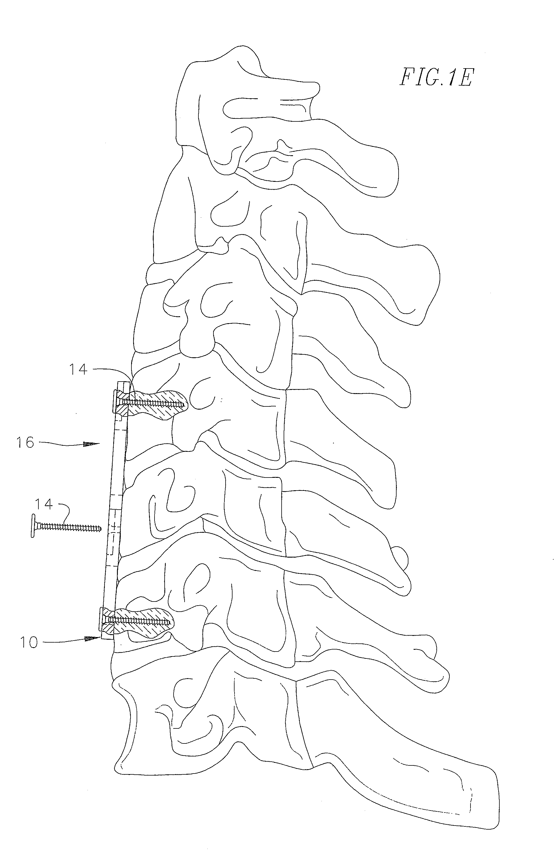 Distraction device for use with a revisable anterior cervical plating system