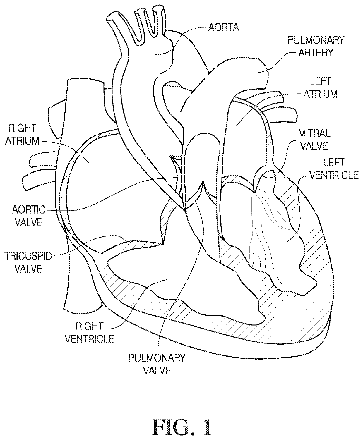 Prosthetic heart valve with collapsible holder