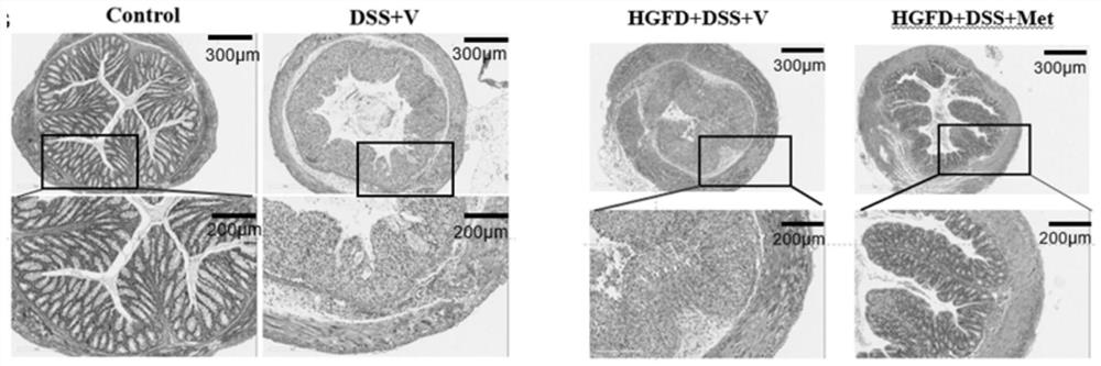 Application of metformin in relief of ulcerative colitis induced by high glucose and high fat