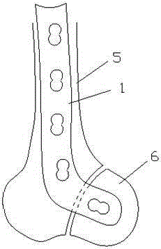 Posterior thighbone internal fixation bone plate