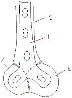 Posterior thighbone internal fixation bone plate