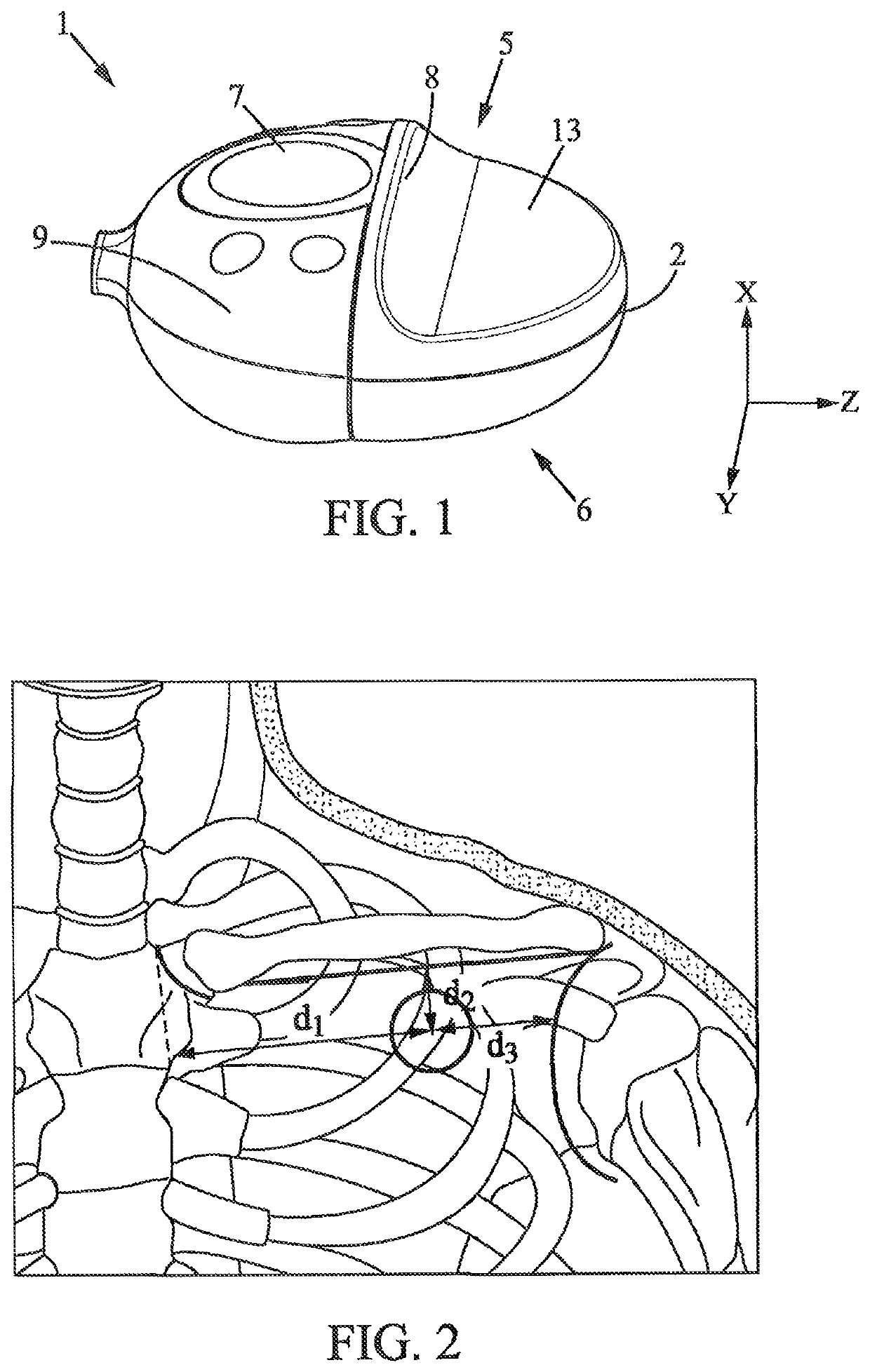 Device for measuring blood flow