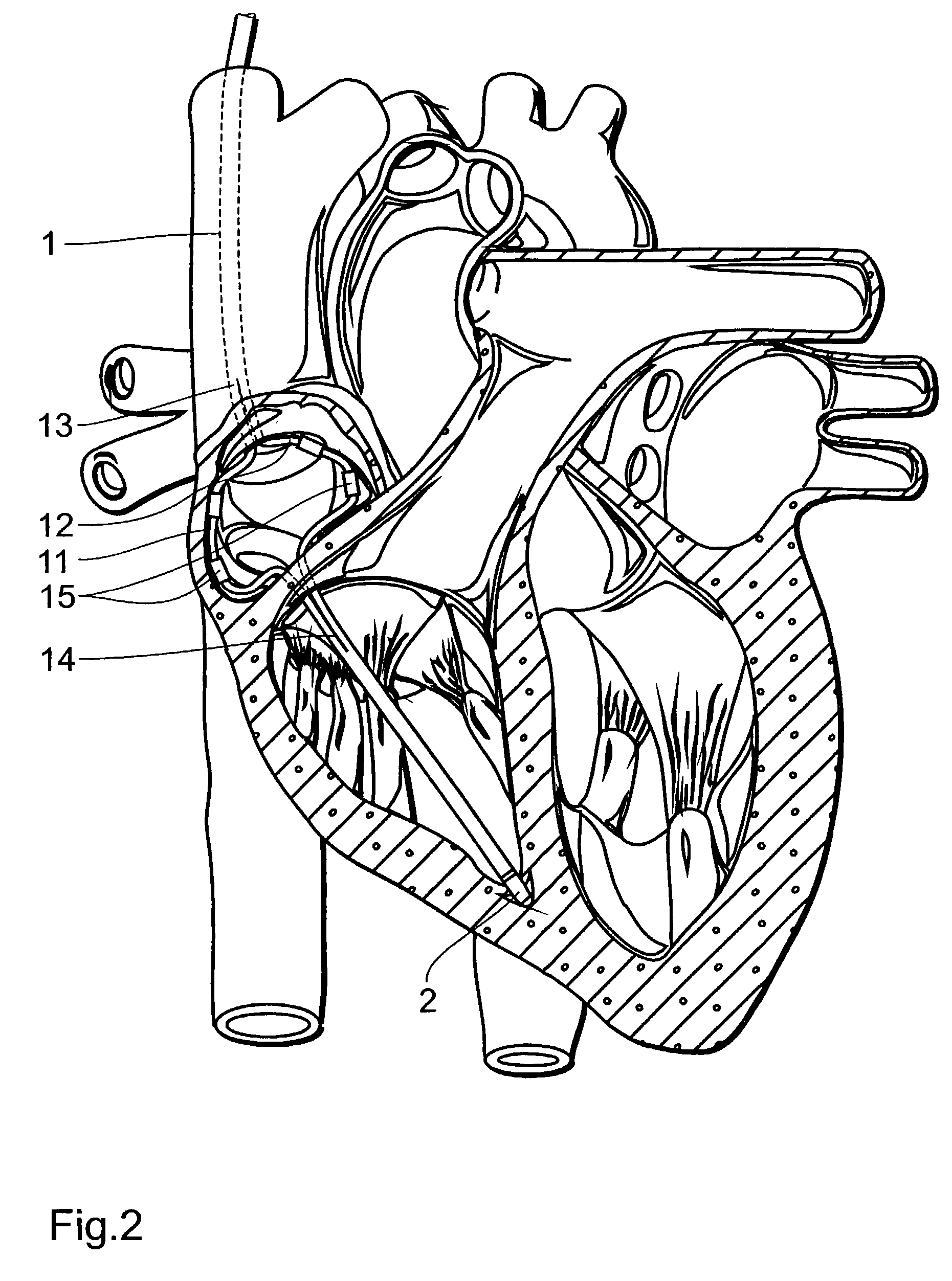 Single electrode probe for a cardiac pacemaker system