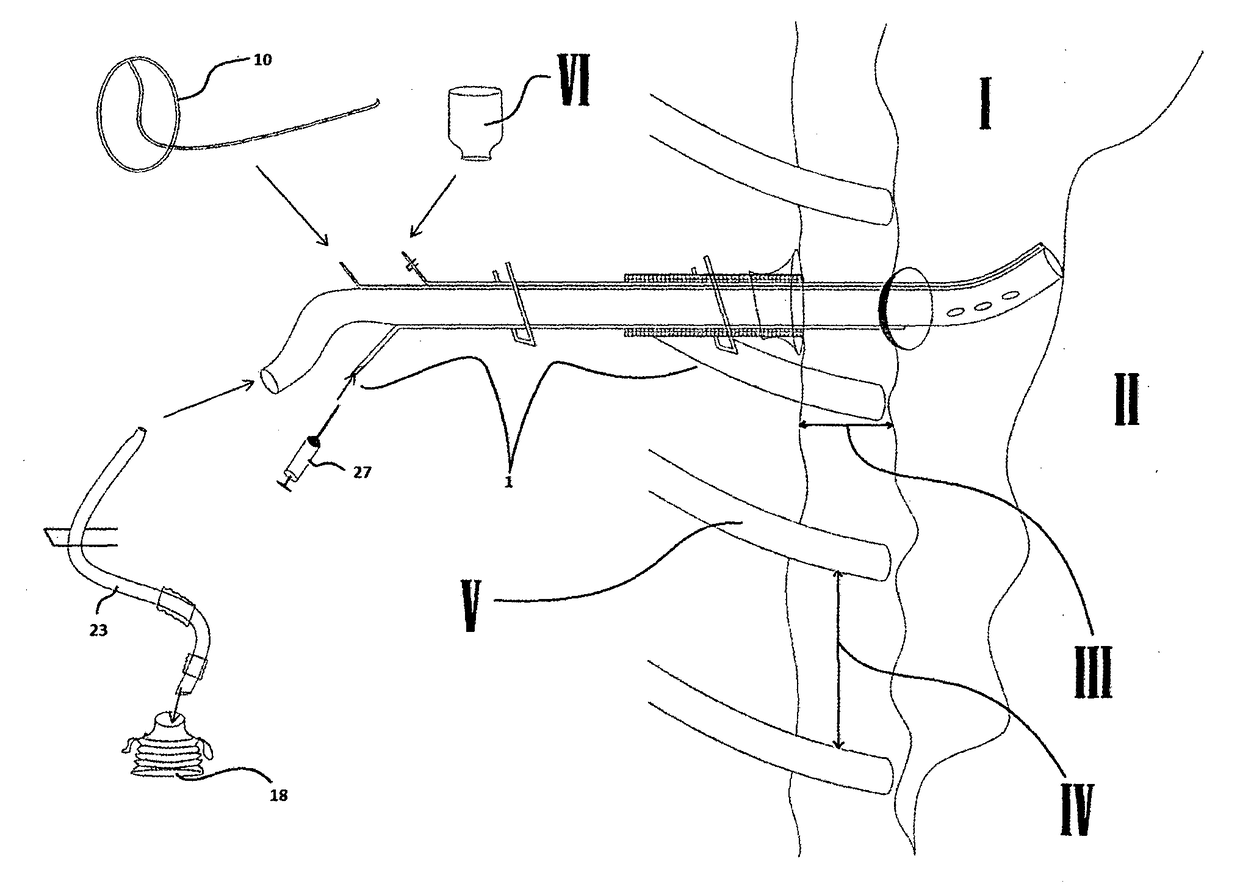 Pleural drainage set and pleural drainage method