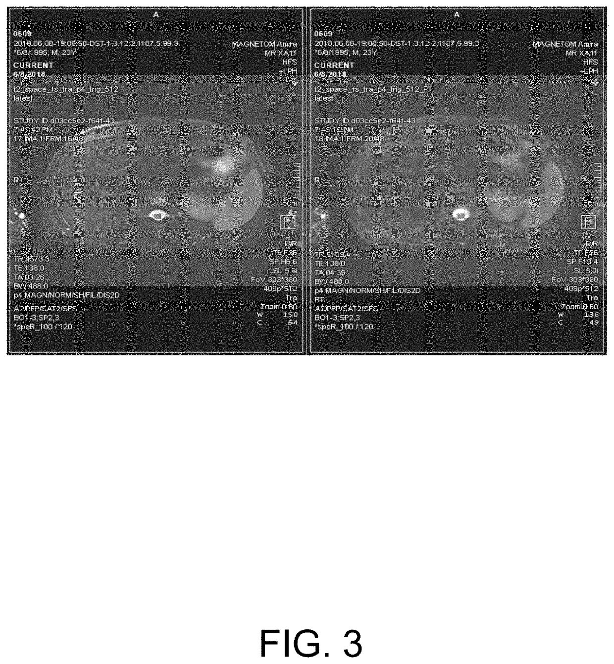 Method and apparatus for correcting interference in respiratory navigation, and storage medium