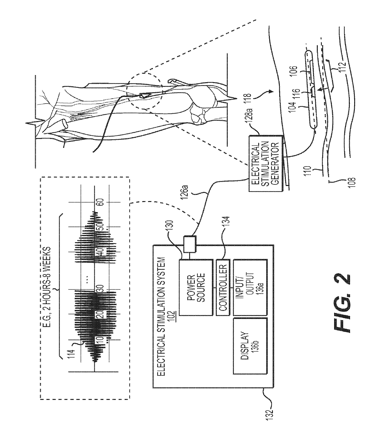 Percutaneous lead placement assembly