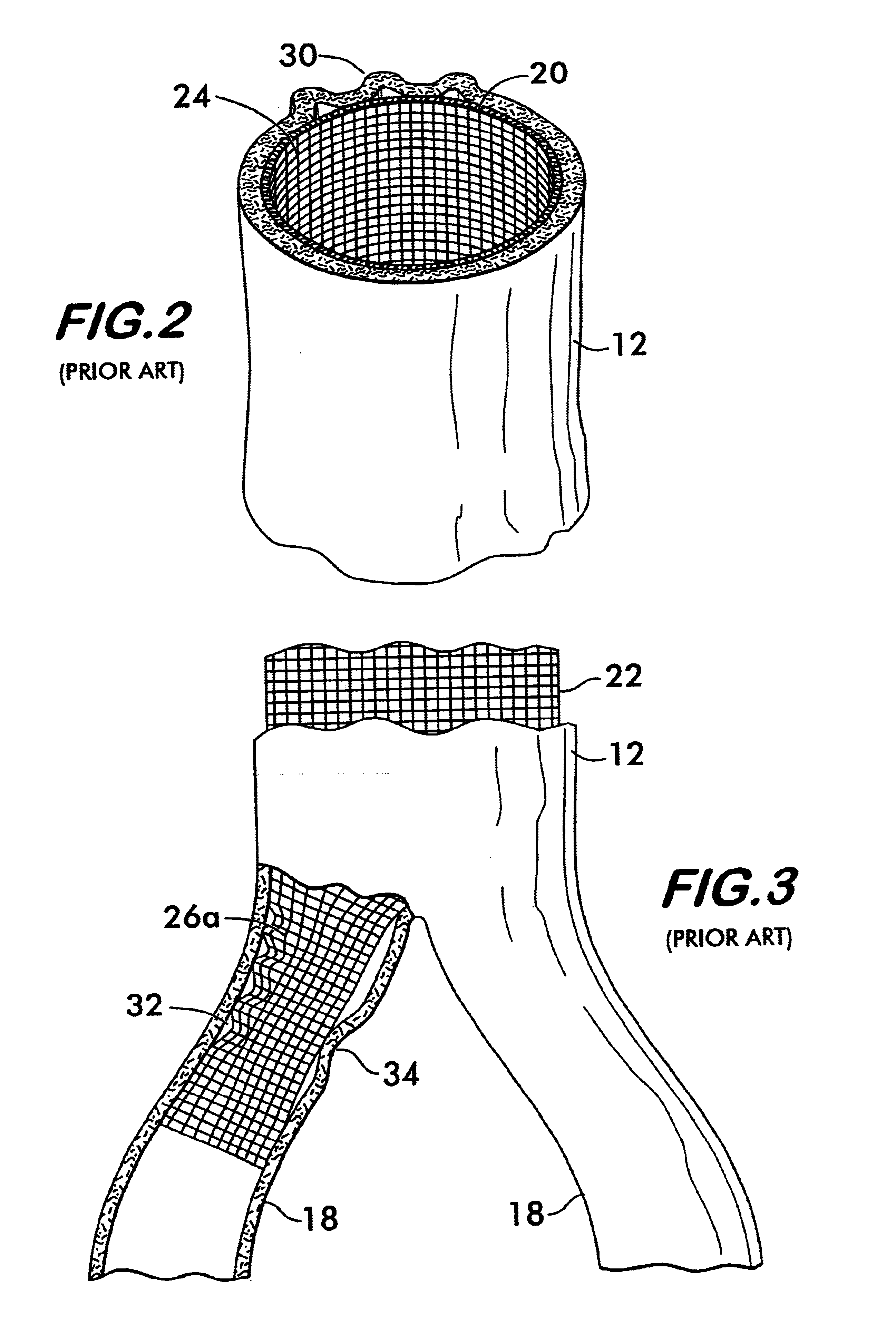 Woven tubular graft with regions of varying flexibility