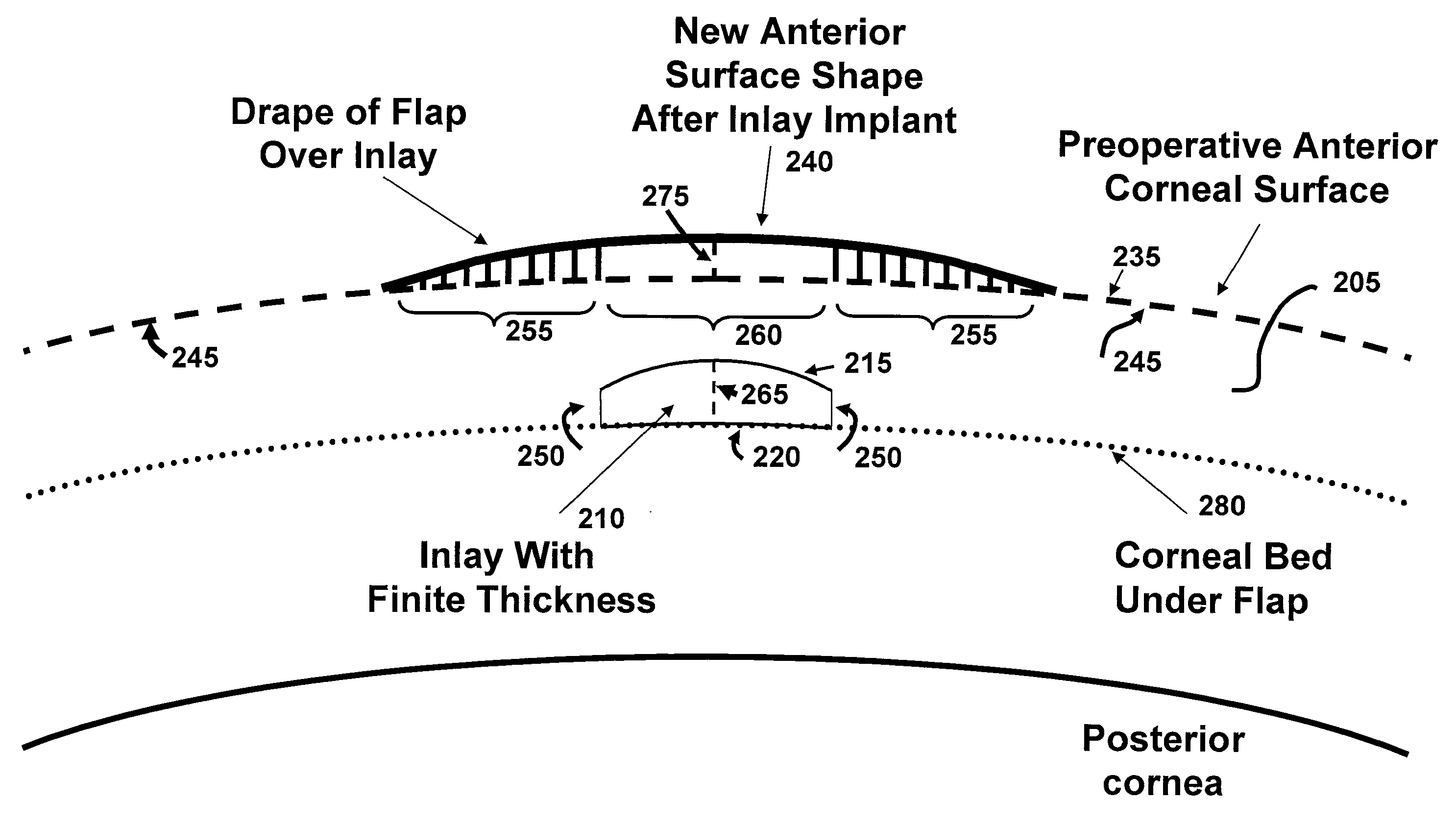 Biomechanical design of intracorneal inlays