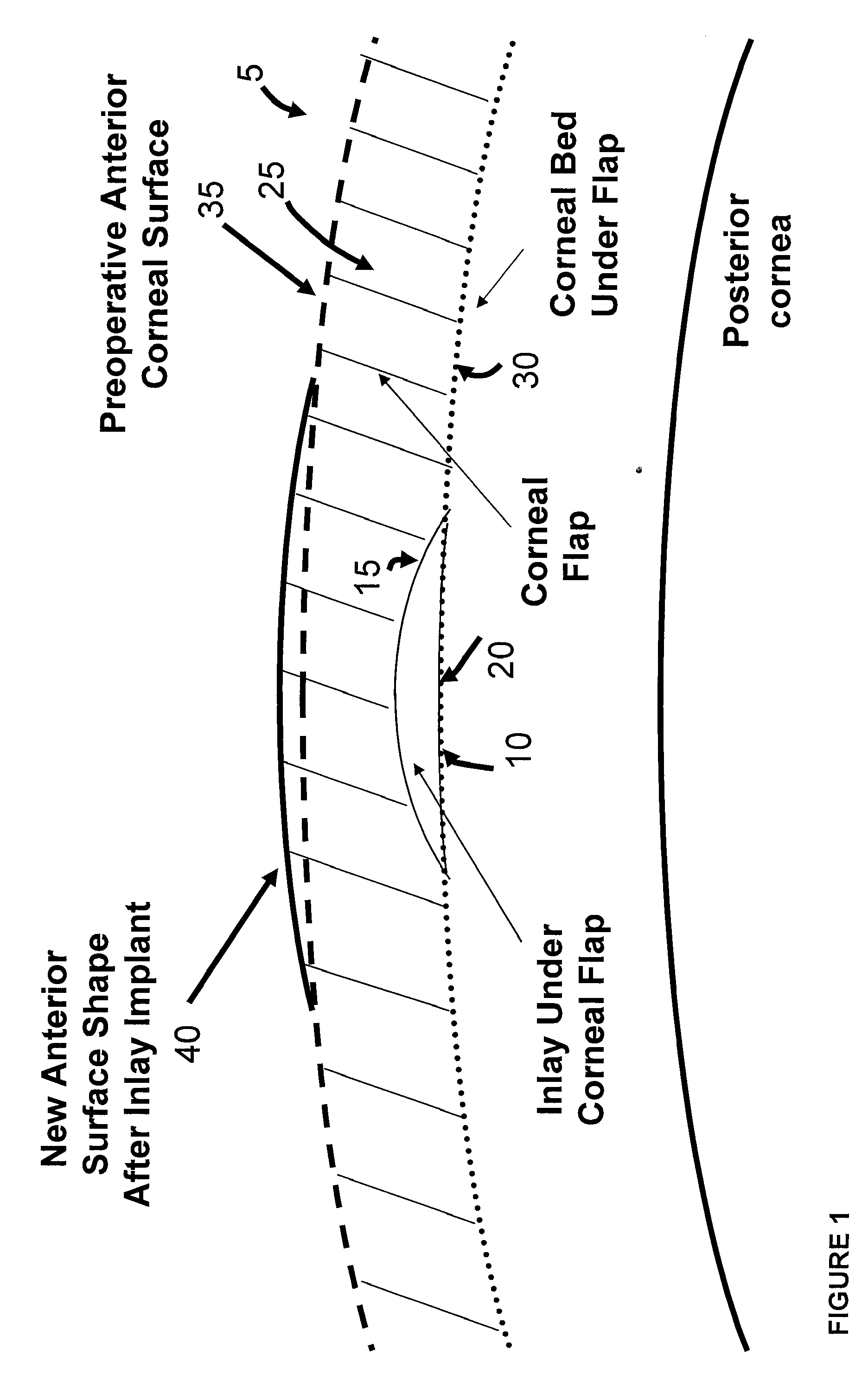 Biomechanical design of intracorneal inlays