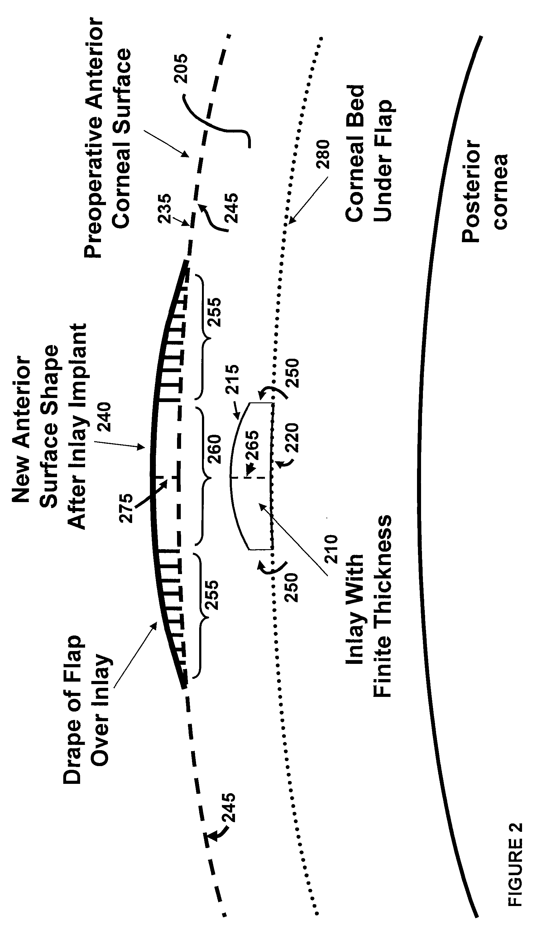 Biomechanical design of intracorneal inlays