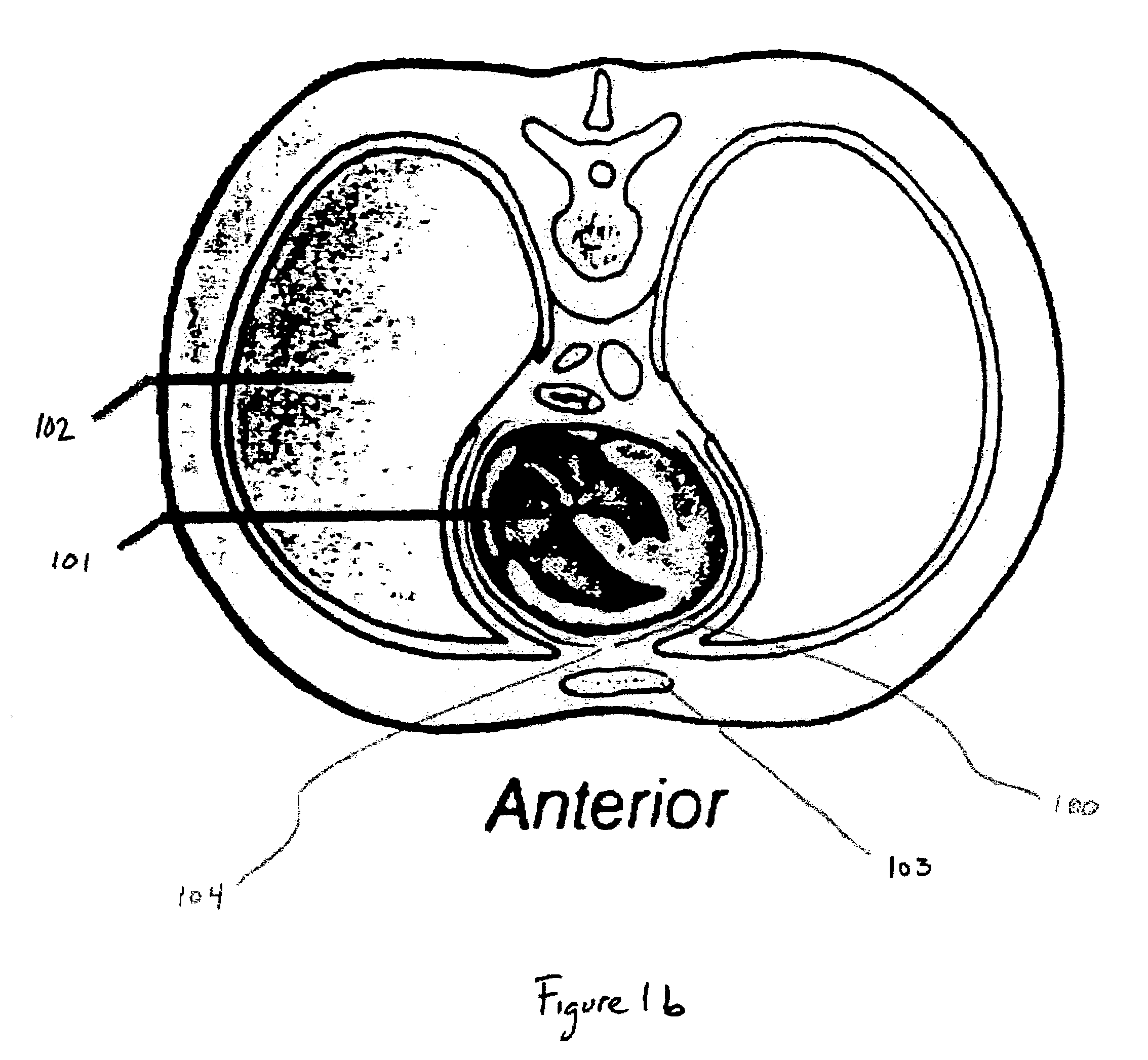 Methods of promoting enhanced healing of tissues after cardiac surgery