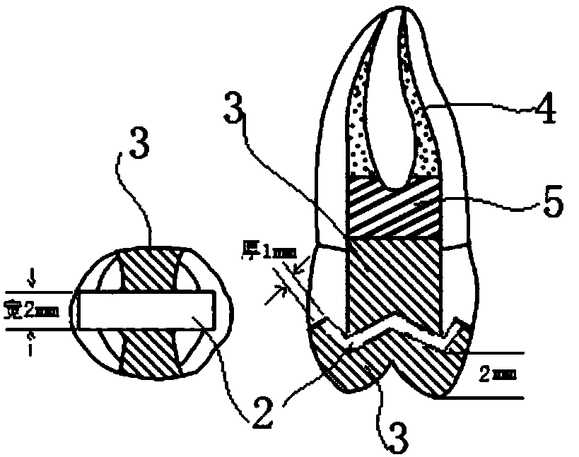 Application of fibrous strip for preparing pulp-perforation cracked molar repairing body