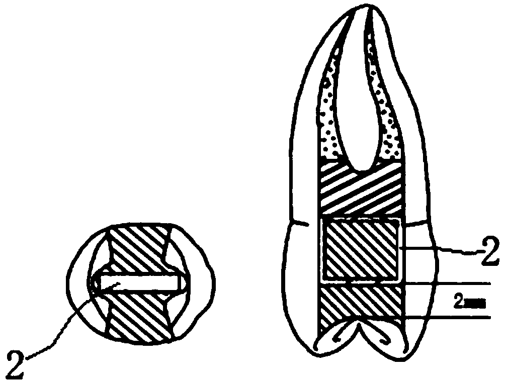 Application of fibrous strip for preparing pulp-perforation cracked molar repairing body