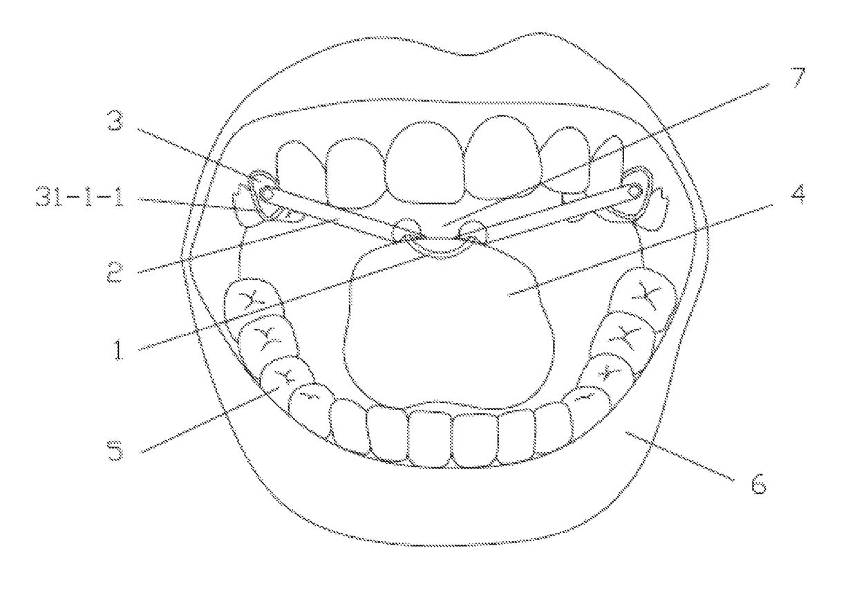 Elastic tongue-dorsum retraction device, clamping pliers, installation pliers, line guide and implantation method