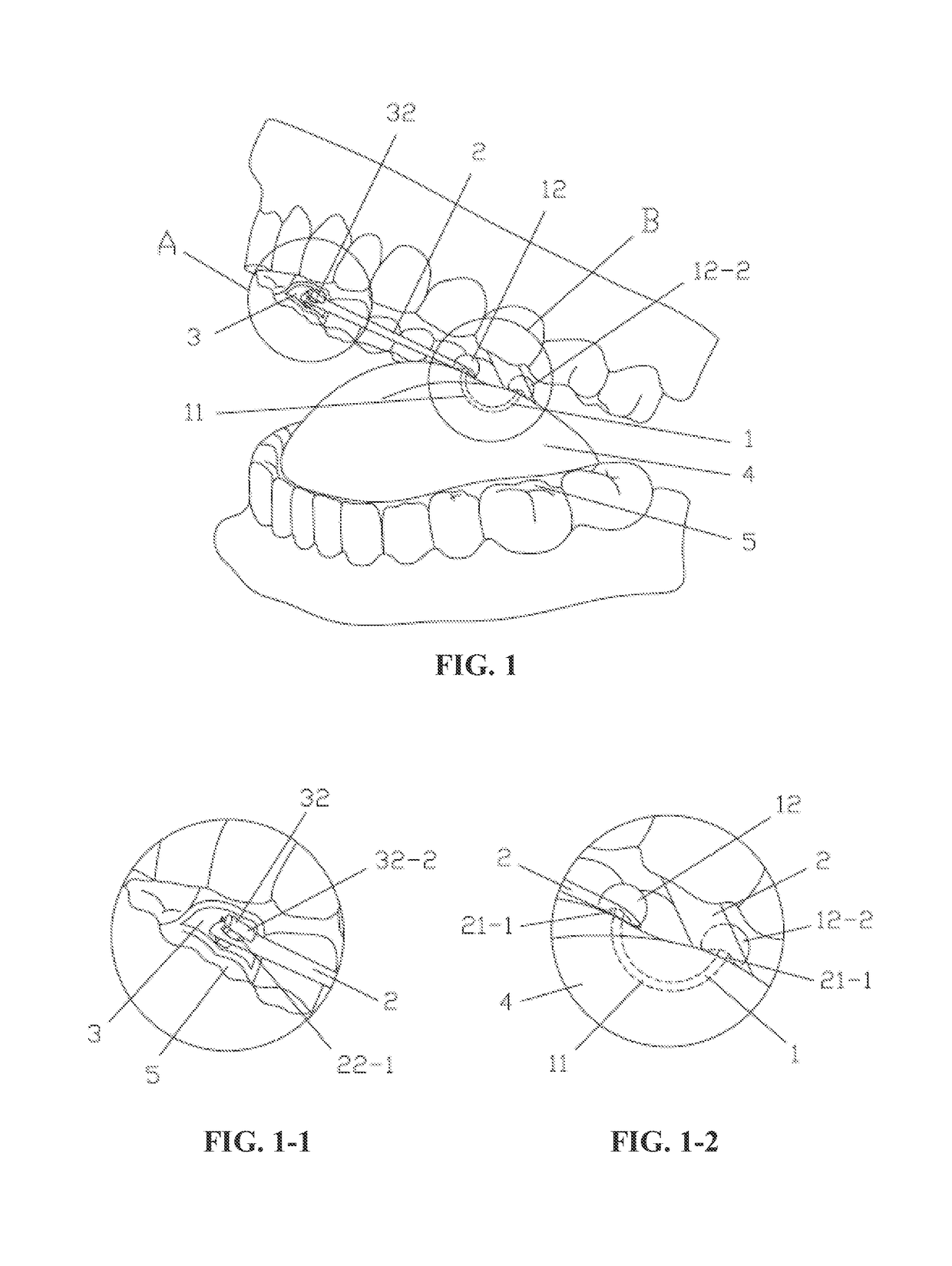 Elastic tongue-dorsum retraction device, clamping pliers, installation pliers, line guide and implantation method