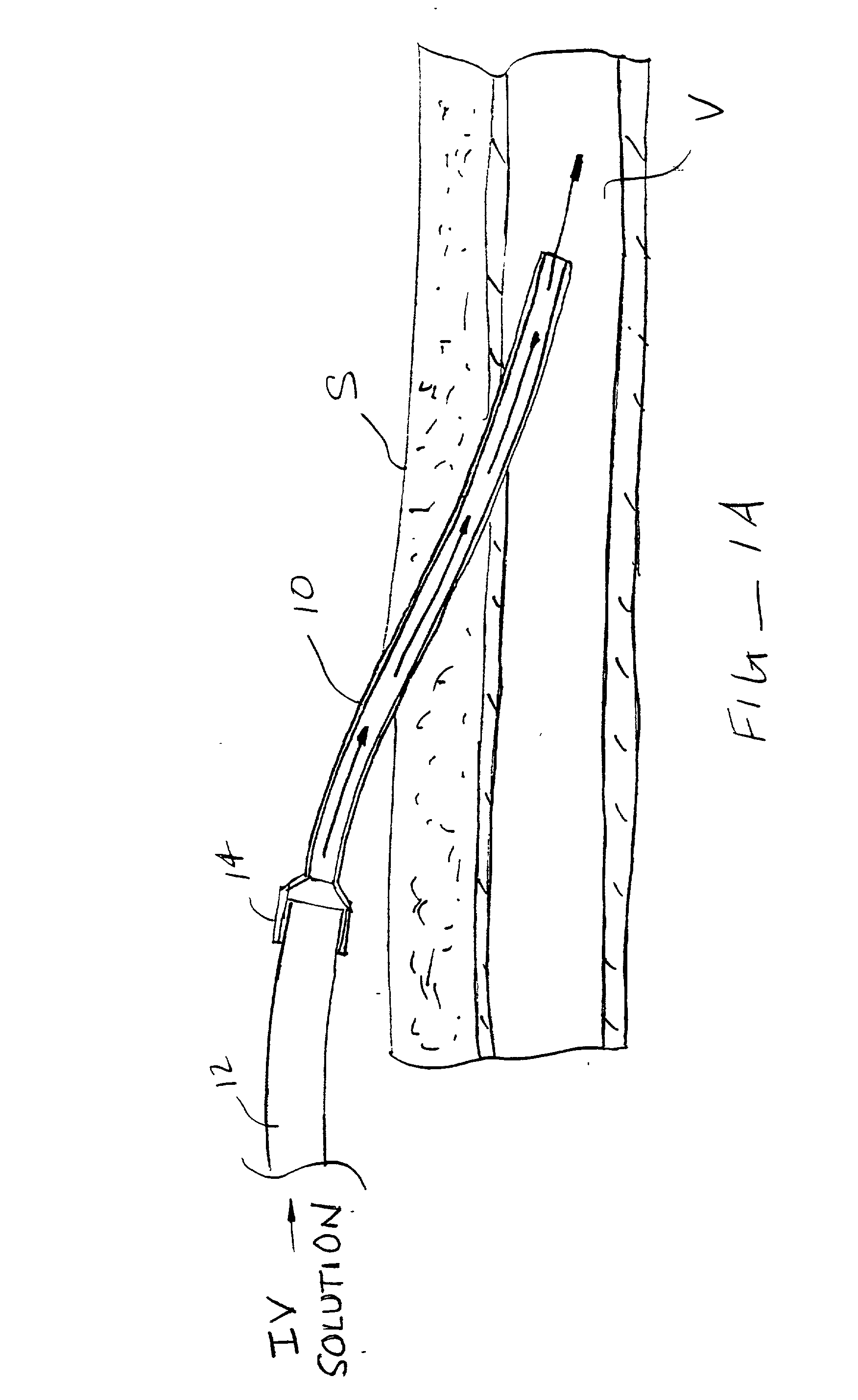 Methods and kits for locking and disinfecting implanted catheters