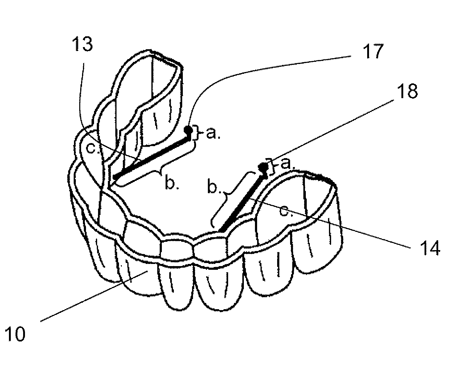 Oral tongue positioning device