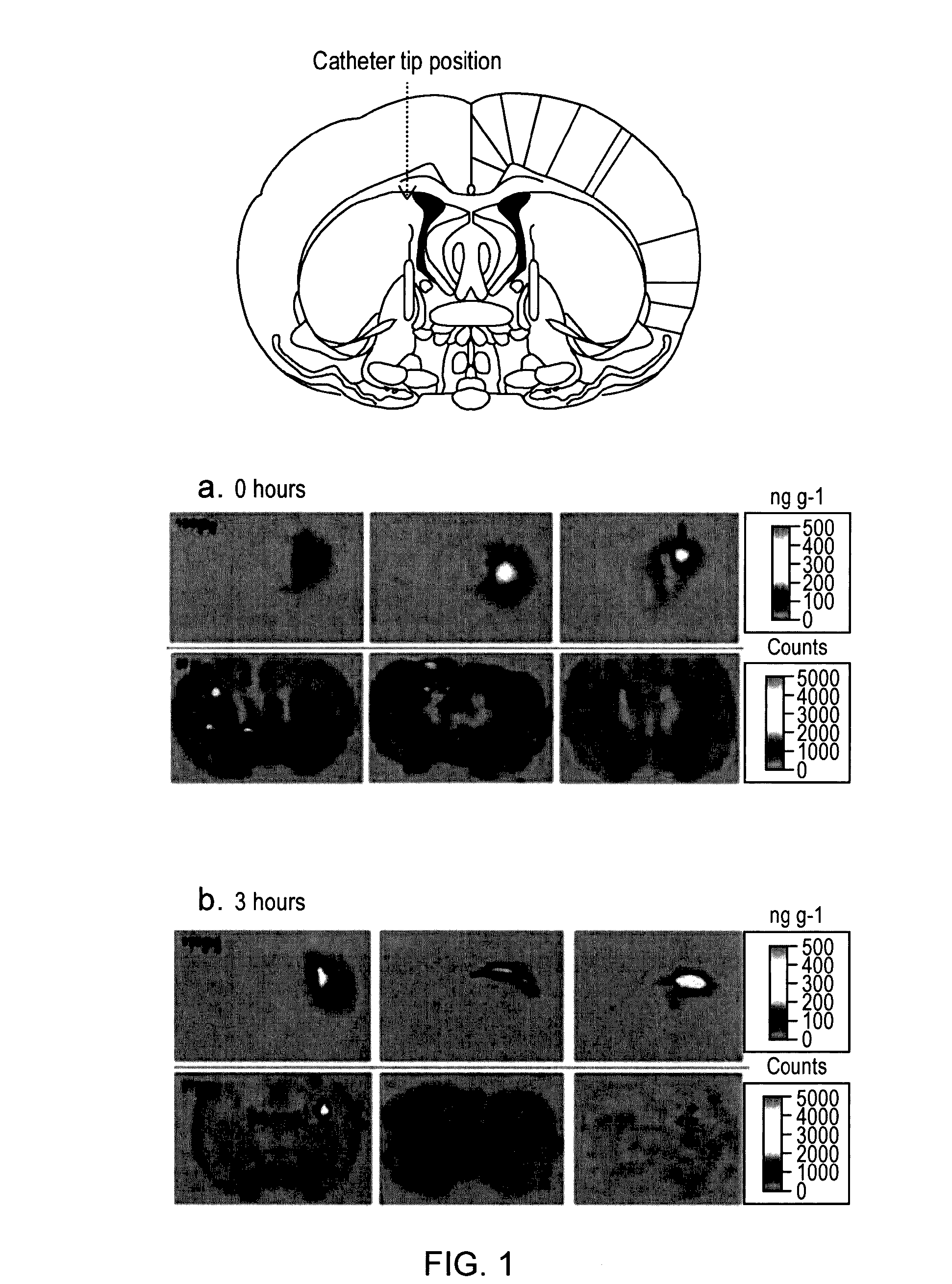 Glioma treatment