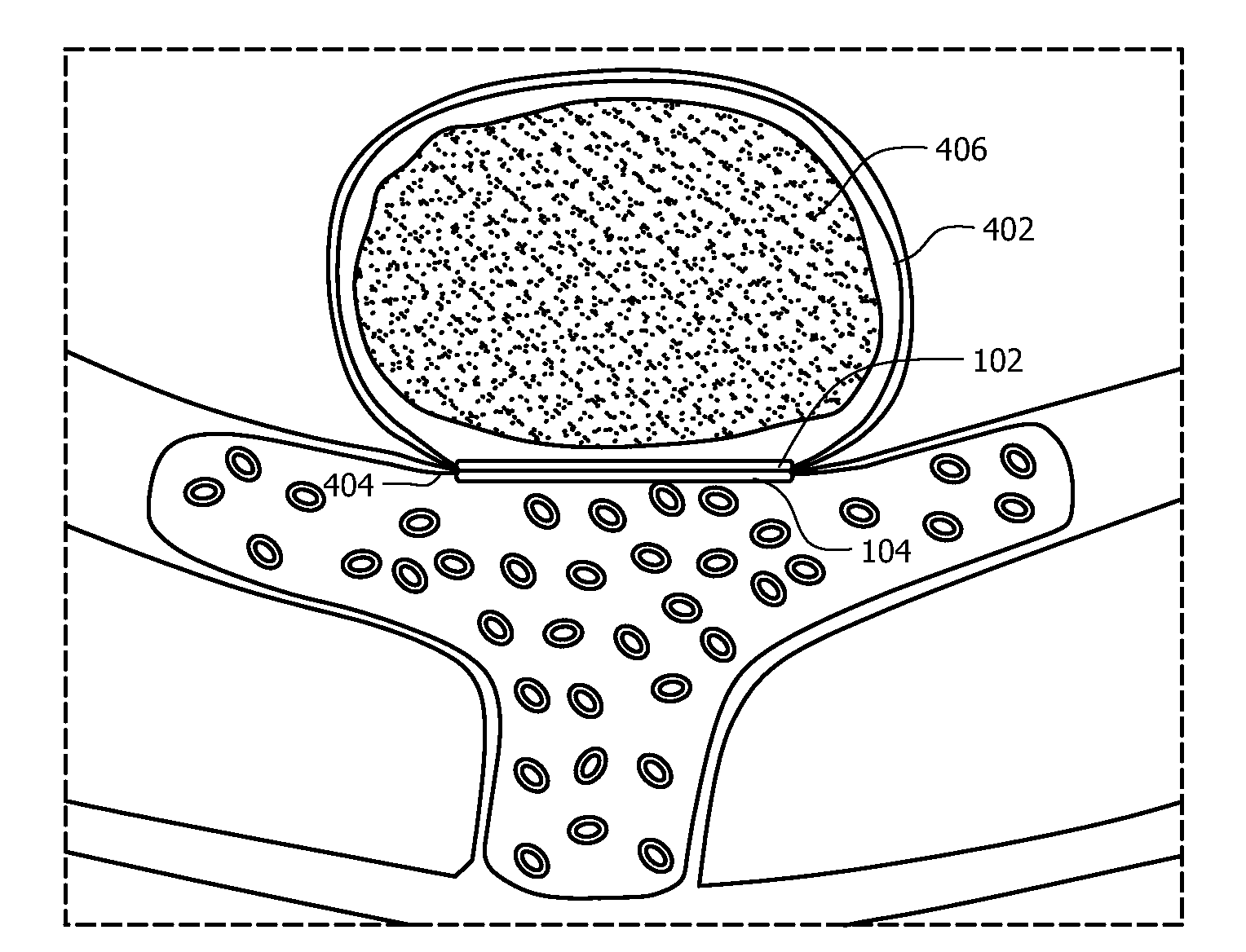 Advanced endovascular clip and method of using same