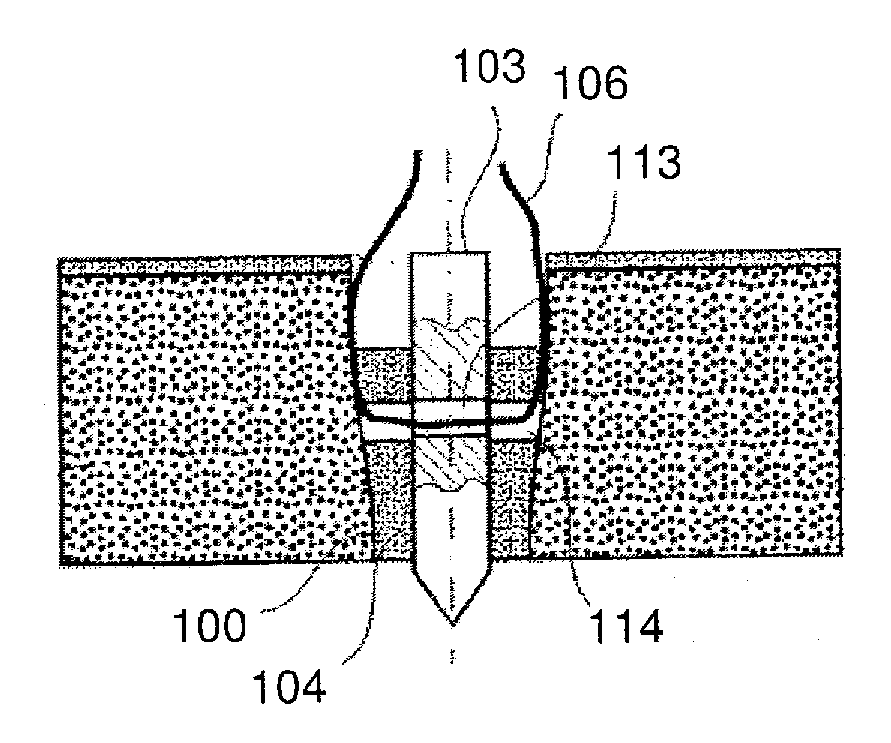 Fixation Device With Magnesium Core