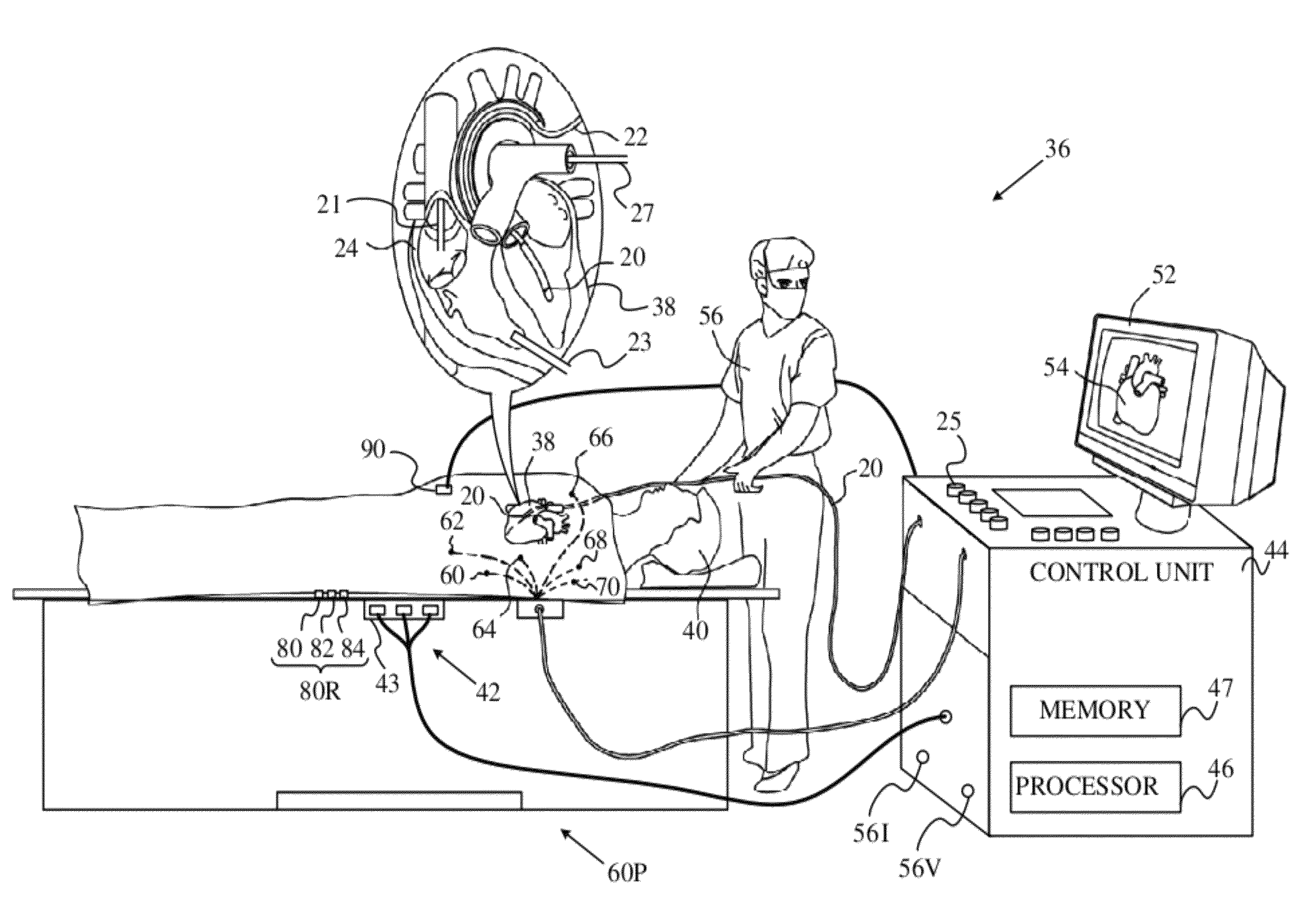 Respiratory effect reduction in catheter position sensing