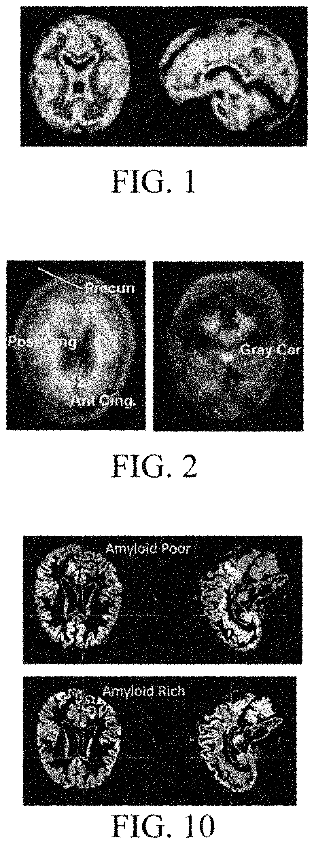 Method for analyzing and correcting measurement variability in PET images