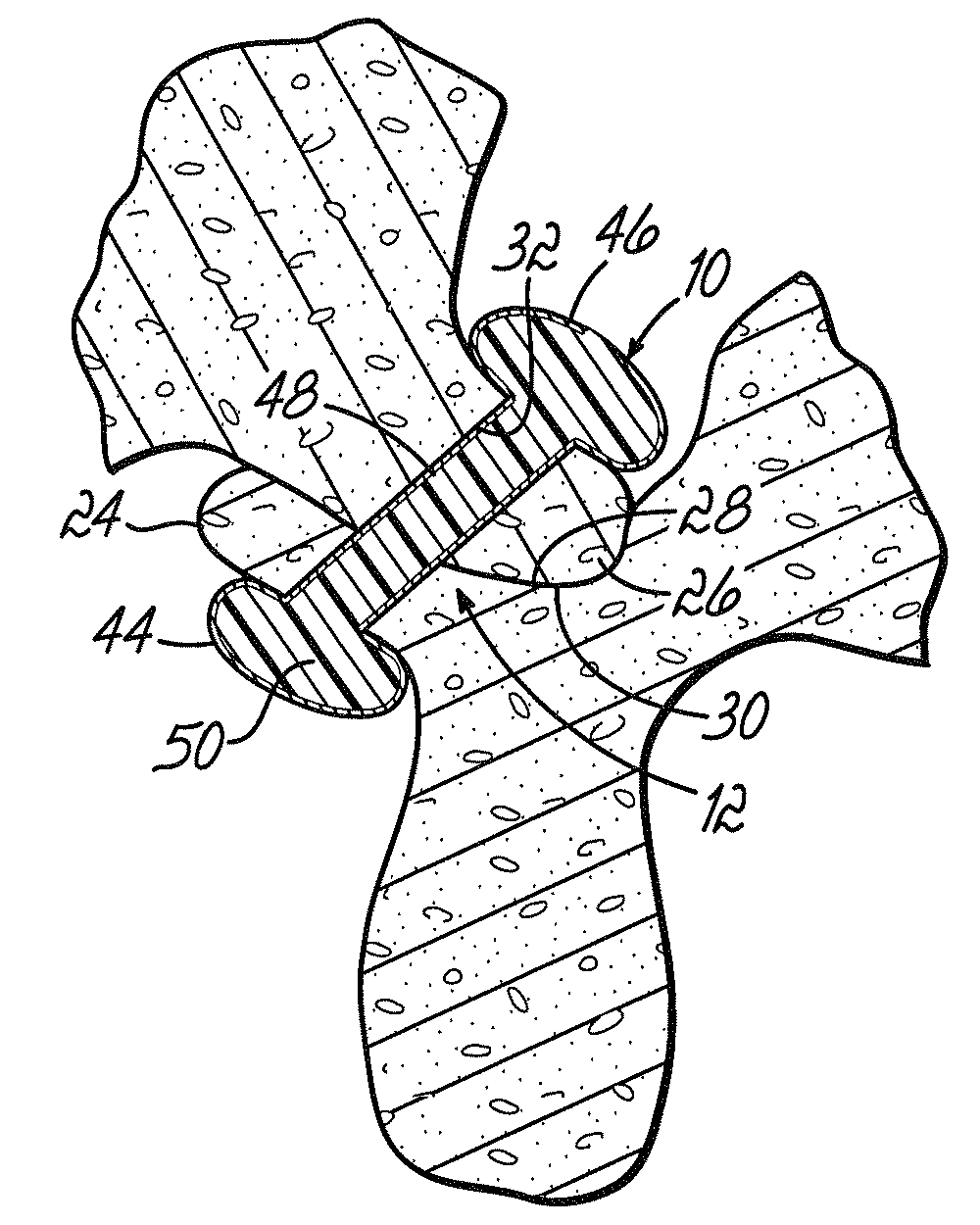 Method for stabilizing a facet joint