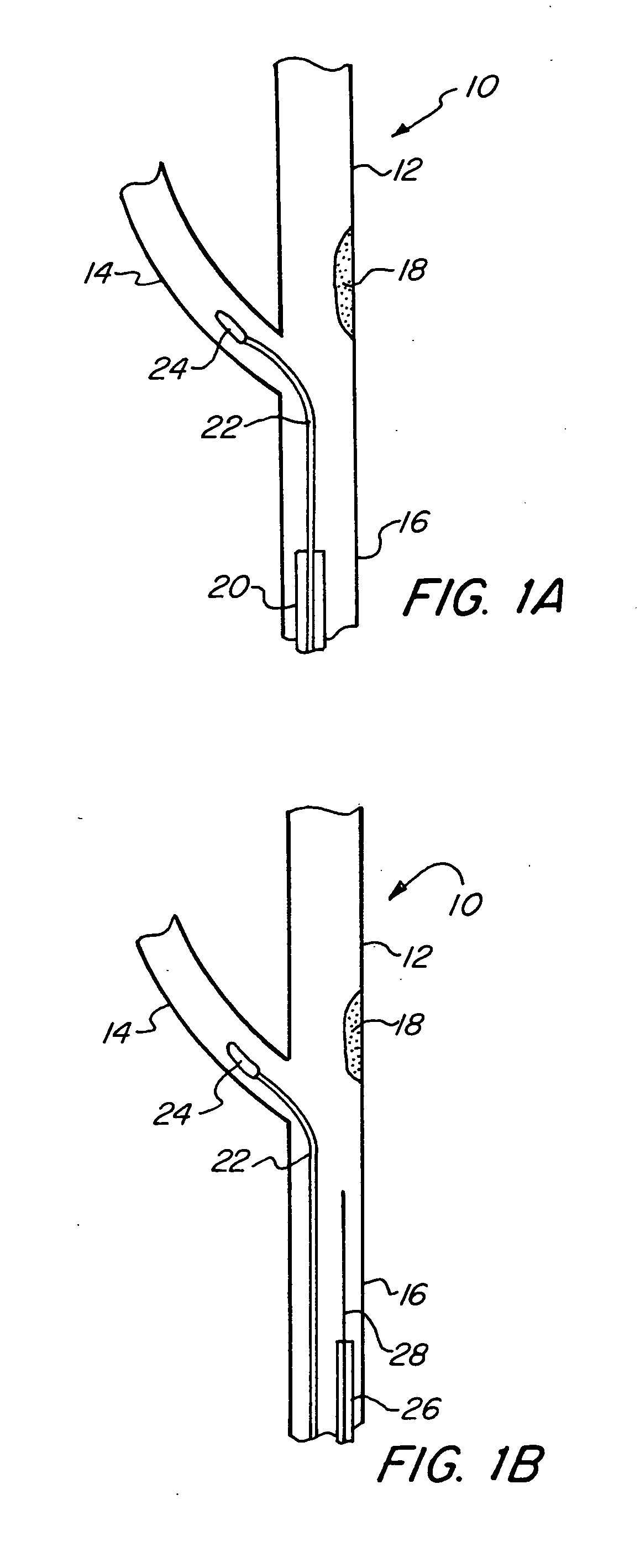 Proximal protection balloon catheter method and device