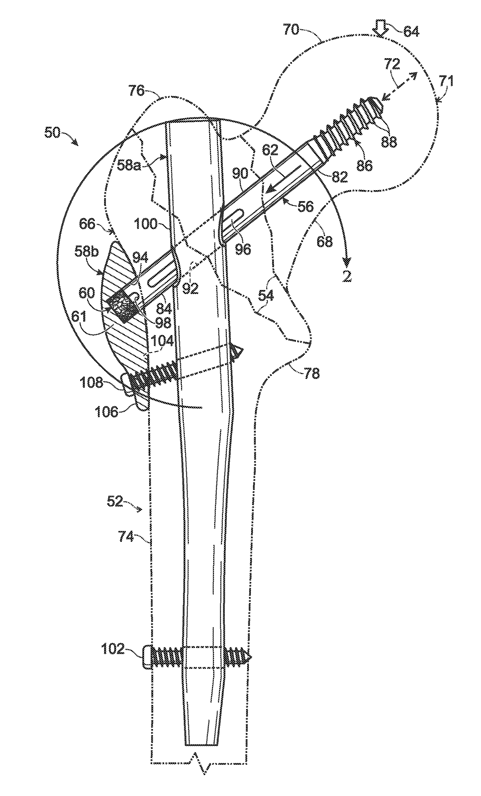 Hip fixation with load-controlled dynamization